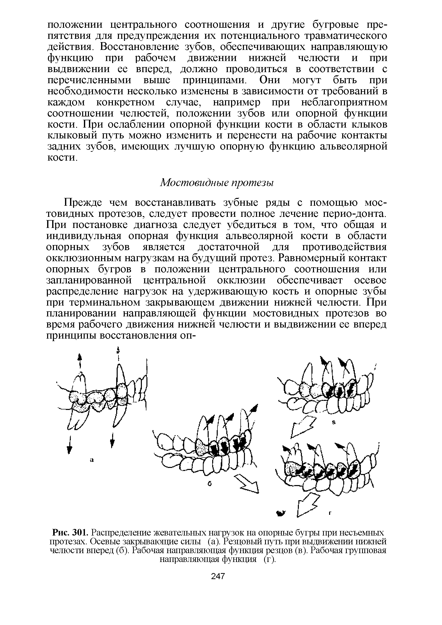 Рис. 301. Распределение жевательных нагрузок на опорные бугры при несъемных протезах. Осевые закрывающие силы (а). Резцовый путь при выдвижении нижней челюсти вперед (б). Рабочая направляющая функция резцов (в). Рабочая групповая направляющая функция (г).