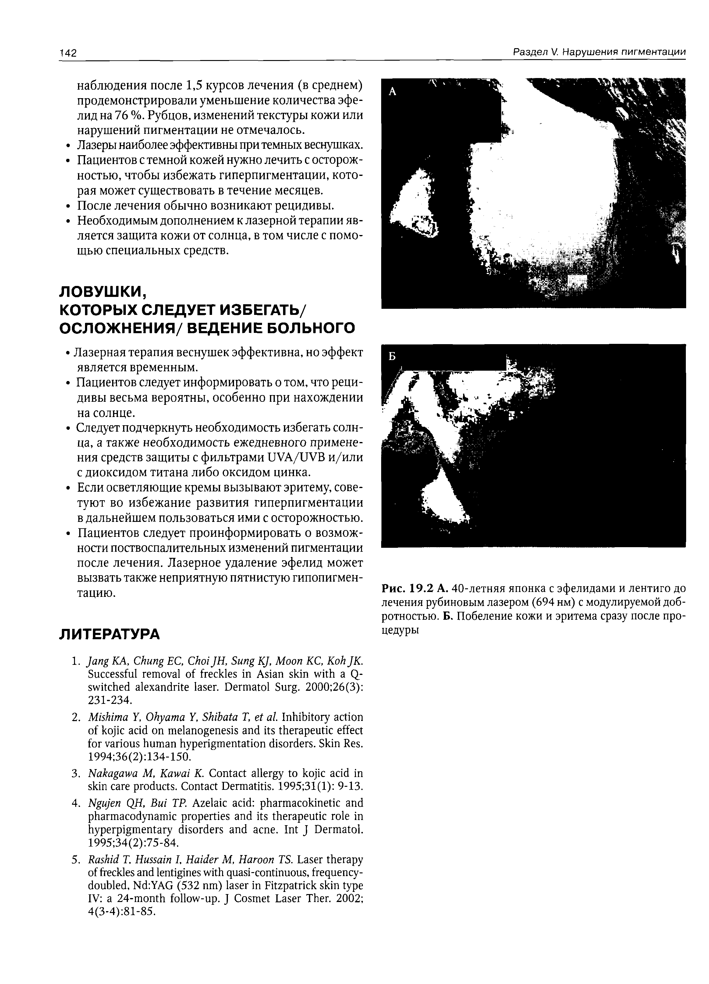 Рис. 19.2 А. 40-летняя японка с эфелидами и лентиго до лечения рубиновым лазером (694 нм) с модулируемой добротностью. Б. Побеление кожи и эритема сразу после процедуры...