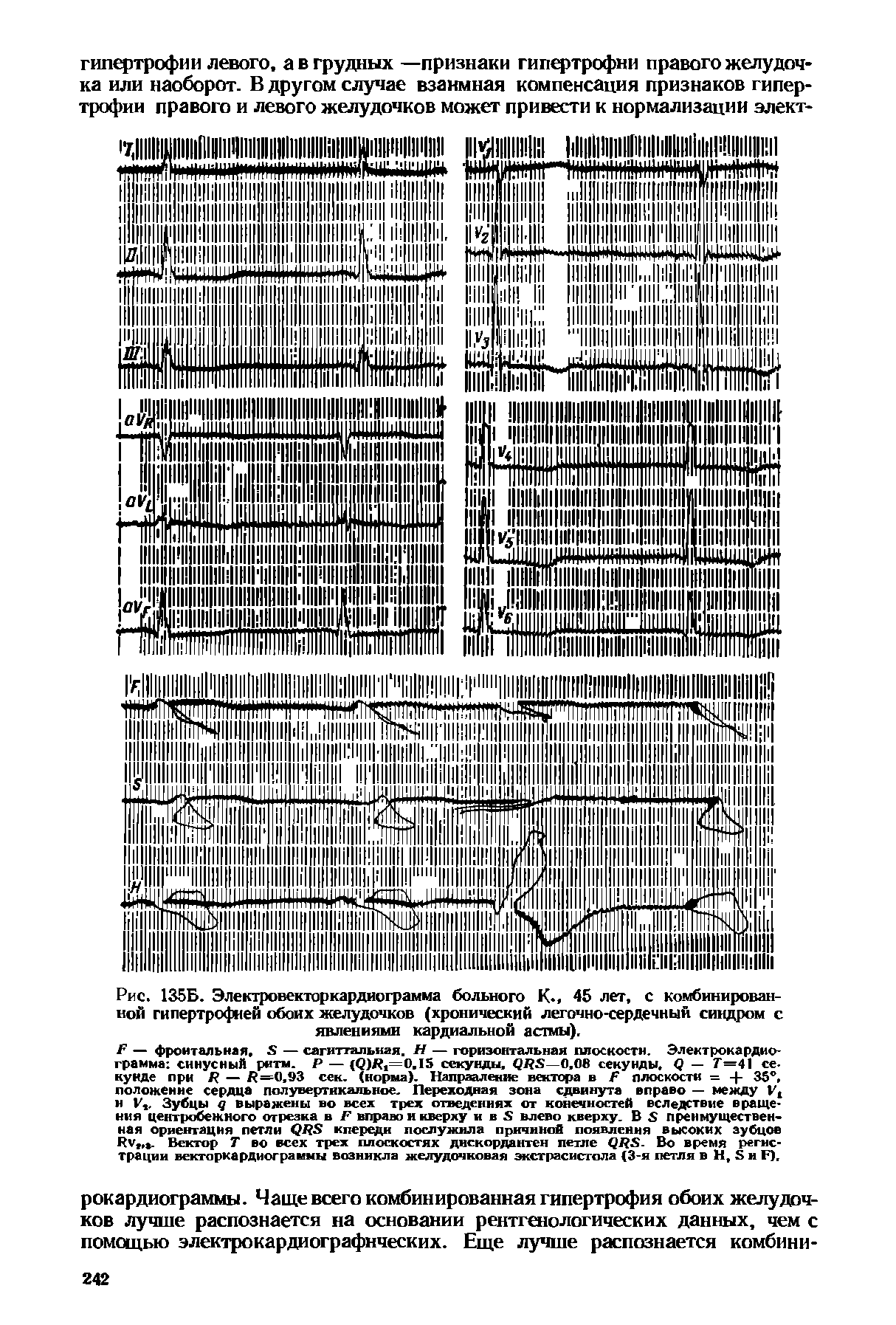 Рис. 135Б. Электровекторкардиограмма больного К.. 45 лет, с комбинированной гипертрофией обоих желудочков (хронический легочно-сердечный синдром с явлениями кардиальной астмы),...