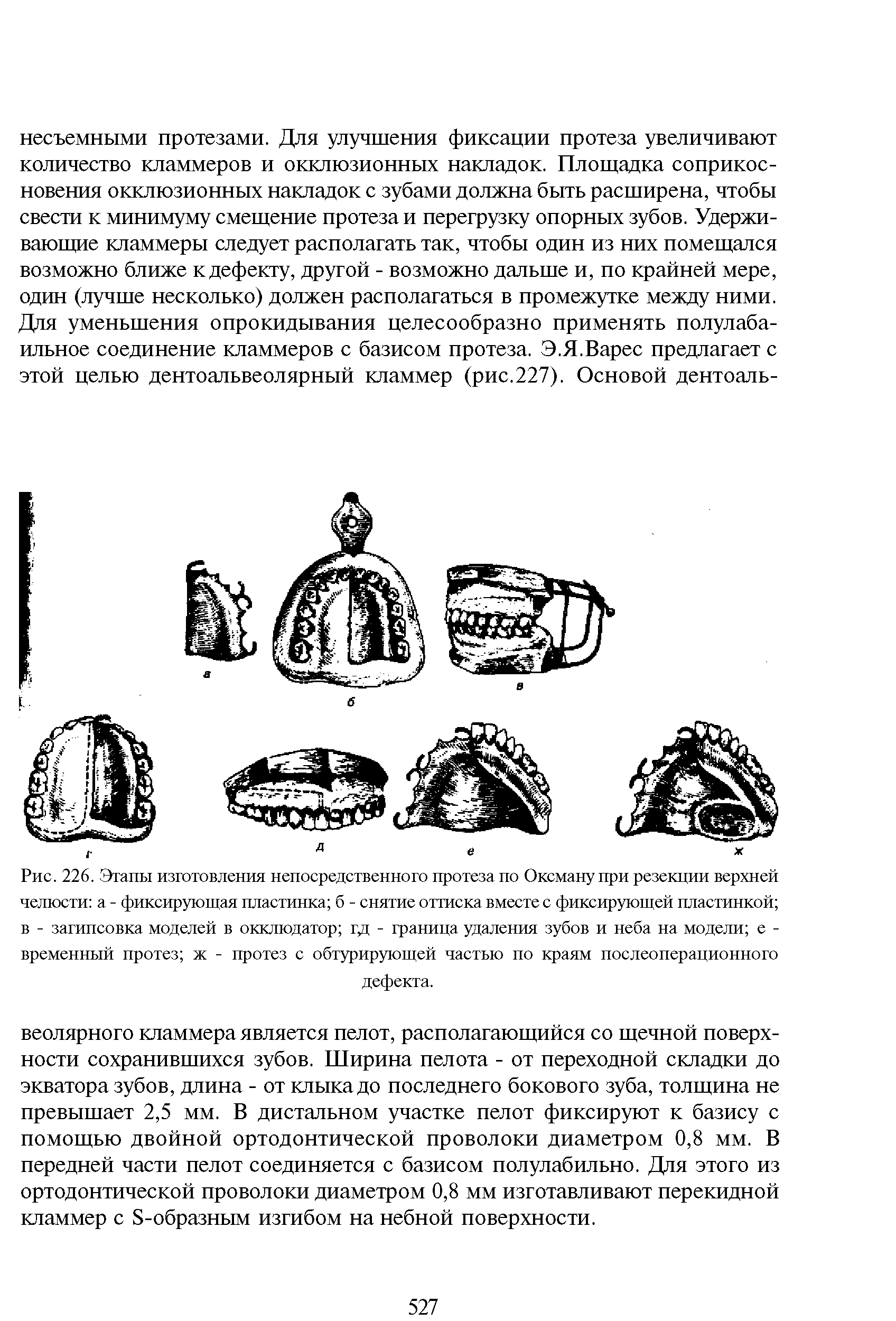 Рис. 226. Этапы изготовления непосредственного протеза по Оксману при резекции верхней челюсти а - фиксирующая пластинка б - снятие оттиска вместе с фиксирующей пластинкой в - загипсовка моделей в окклюдатор гд - граница удаления зубов и неба на модели е -временный протез ж - протез с обтурирующей частью по краям послеоперационного...
