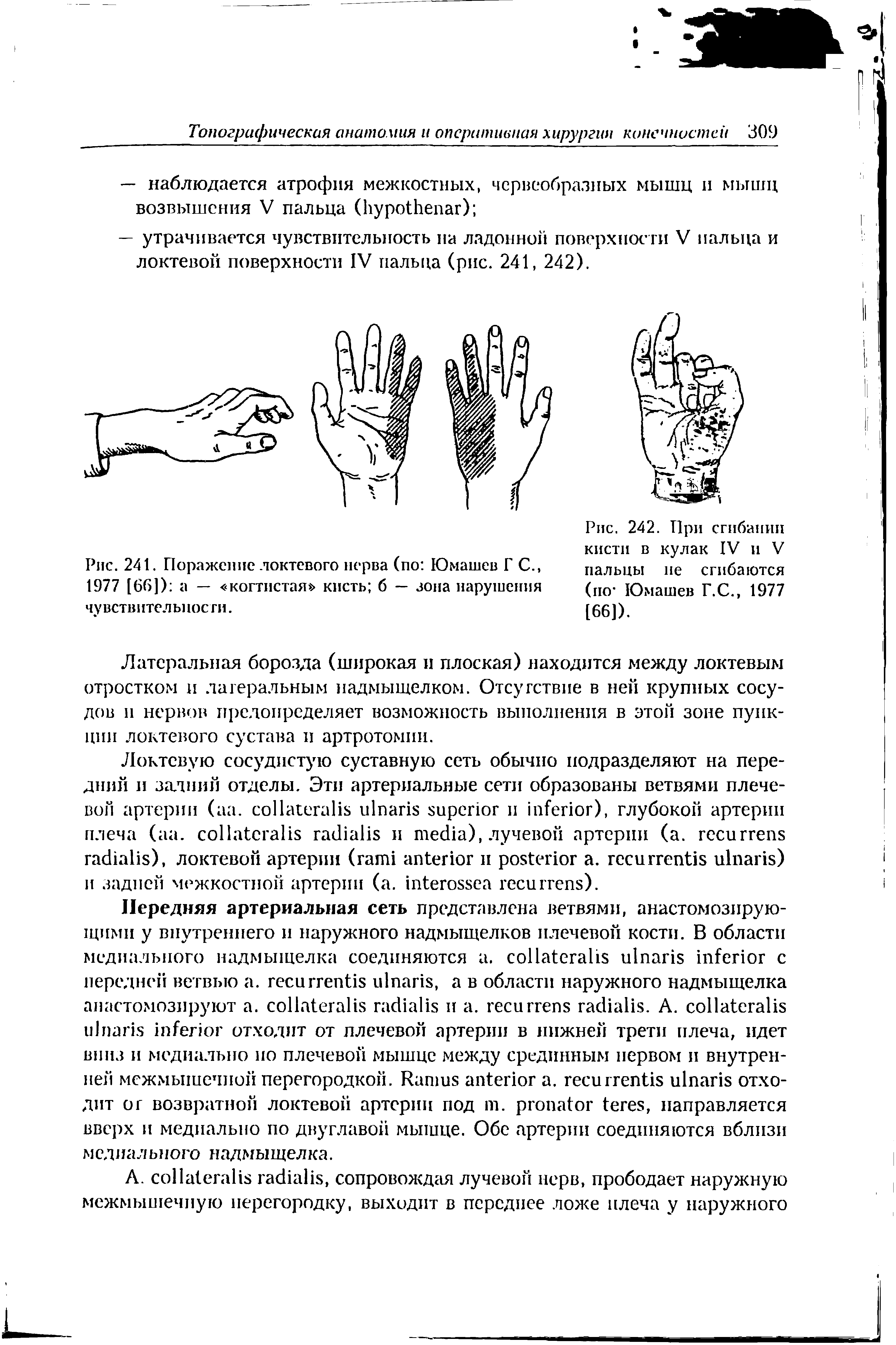 Рис. 241. Поражение локтевого нерва (по Юмашев Г С., 1977 [66]) а — когтистая кисть б — зона нарушения чу вств 11те л ы юсти.