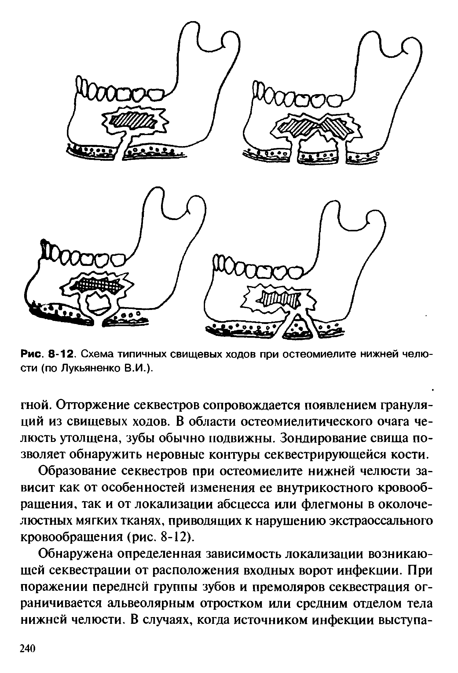 Рис. 8-12. Схема типичных свищевых ходов при остеомиелите нижней челюсти (по Лукьяненко В.И.).