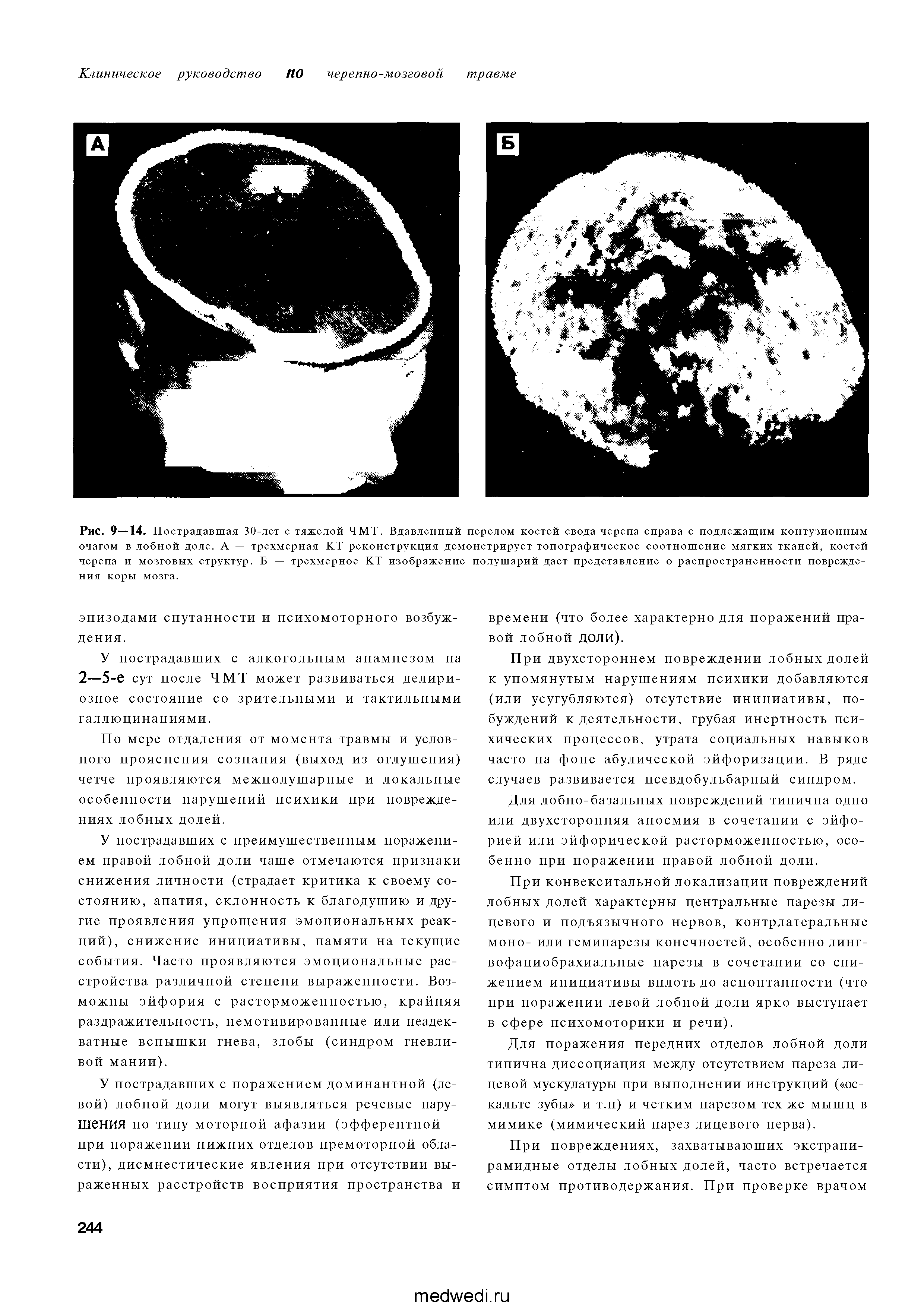 Рис. 9—14. Пострадавшая 30-лет с тяжелой ЧМТ. Вдавленный перелом костей свода черепа справа с подлежащим контузионным очагом в лобной доле. А — трехмерная КТ реконструкция демонстрирует топографическое соотношение мягких тканей, костей черепа и мозговых структур. Б — трехмерное КТ изображение полушарий дает представление о распространенности повреждения коры мозга.