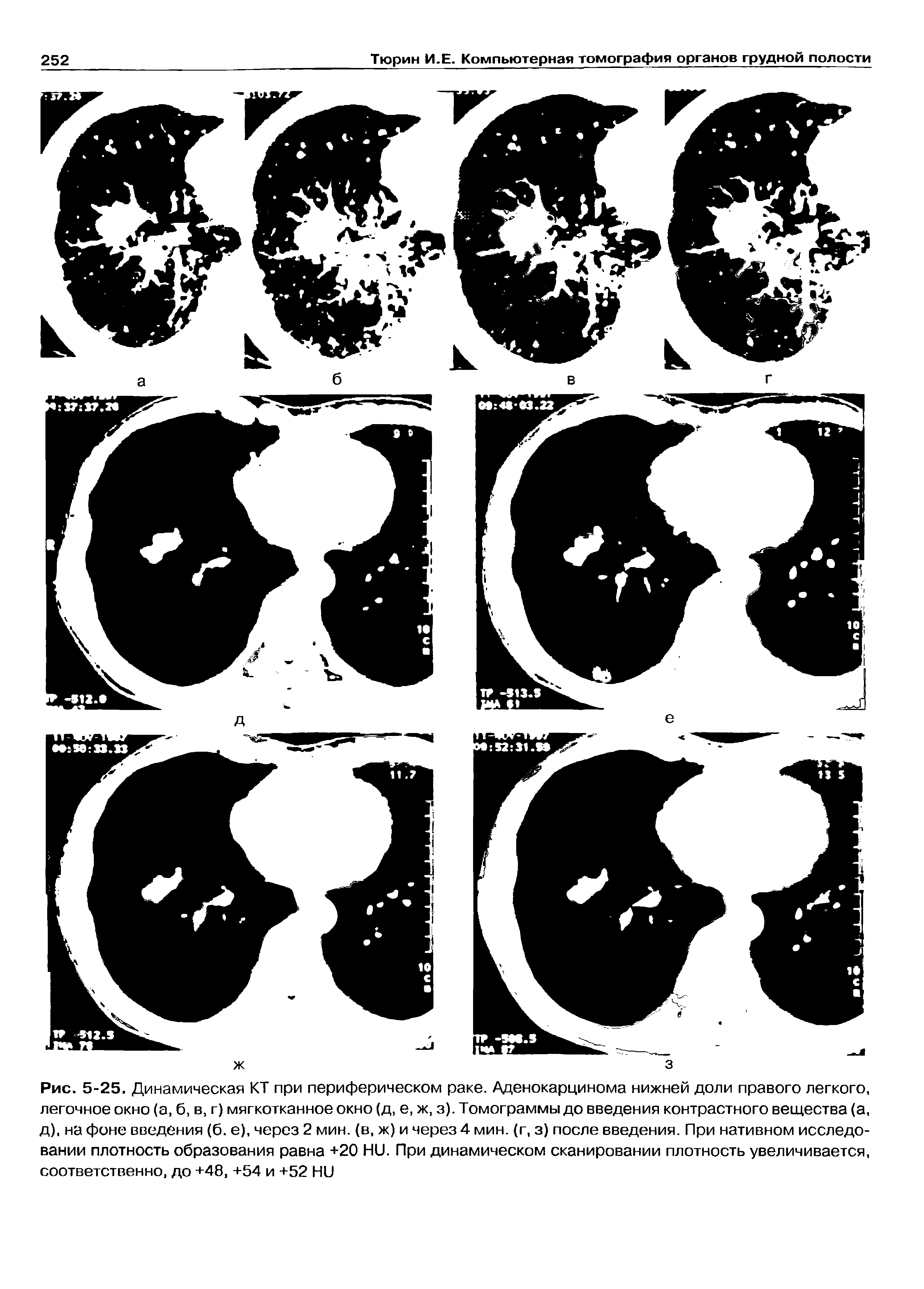 Рис. 5-25. Динамическая КТ при периферическом раке. Аденокарцинома нижней доли правого легкого, легочное окно (а, б, в, г) мягкотканное окно (д, е, ж, з). Томограммы до введения контрастного вещества (а, д), на фоне введения (б. е), через 2 мин. (в, ж) и через 4 мин. (г, з) после введения. При нативном исследовании плотность образования равна +20 Н11. При динамическом сканировании плотность увеличивается, соответственно, до +48, +54 и +52 Ни...