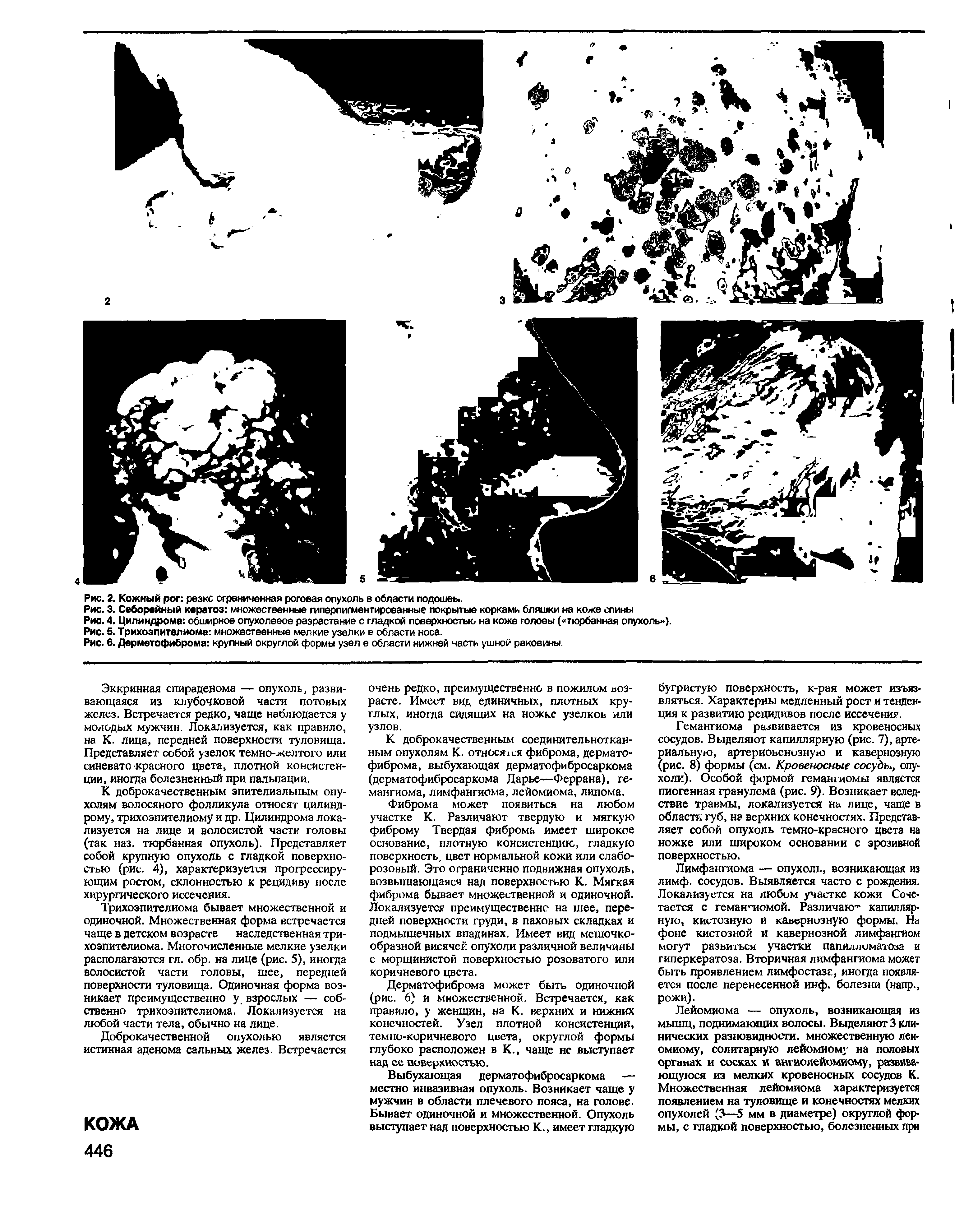 Рис. 3. Себорейный кератоз множественные гиперпигментированные покрытые корками бляшки на коже спины...