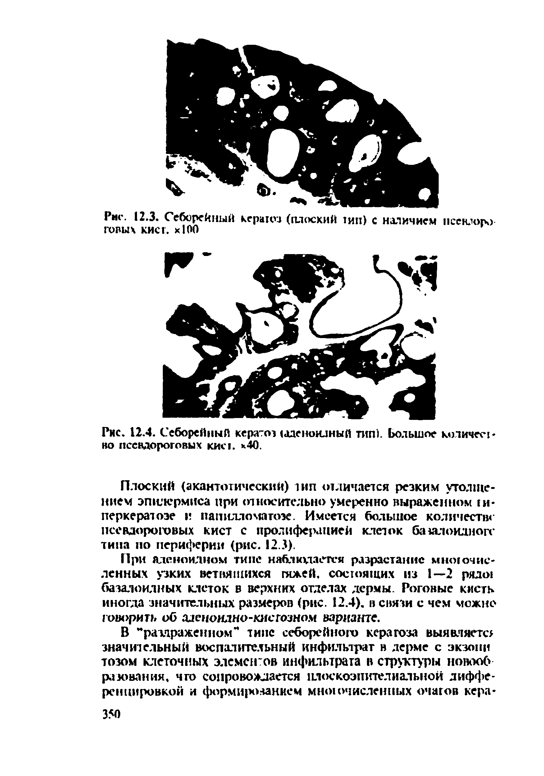 Рис. 12.4. Себорейный кератоз аденоидный тип). большое количество пссвдороговых кист, к40.