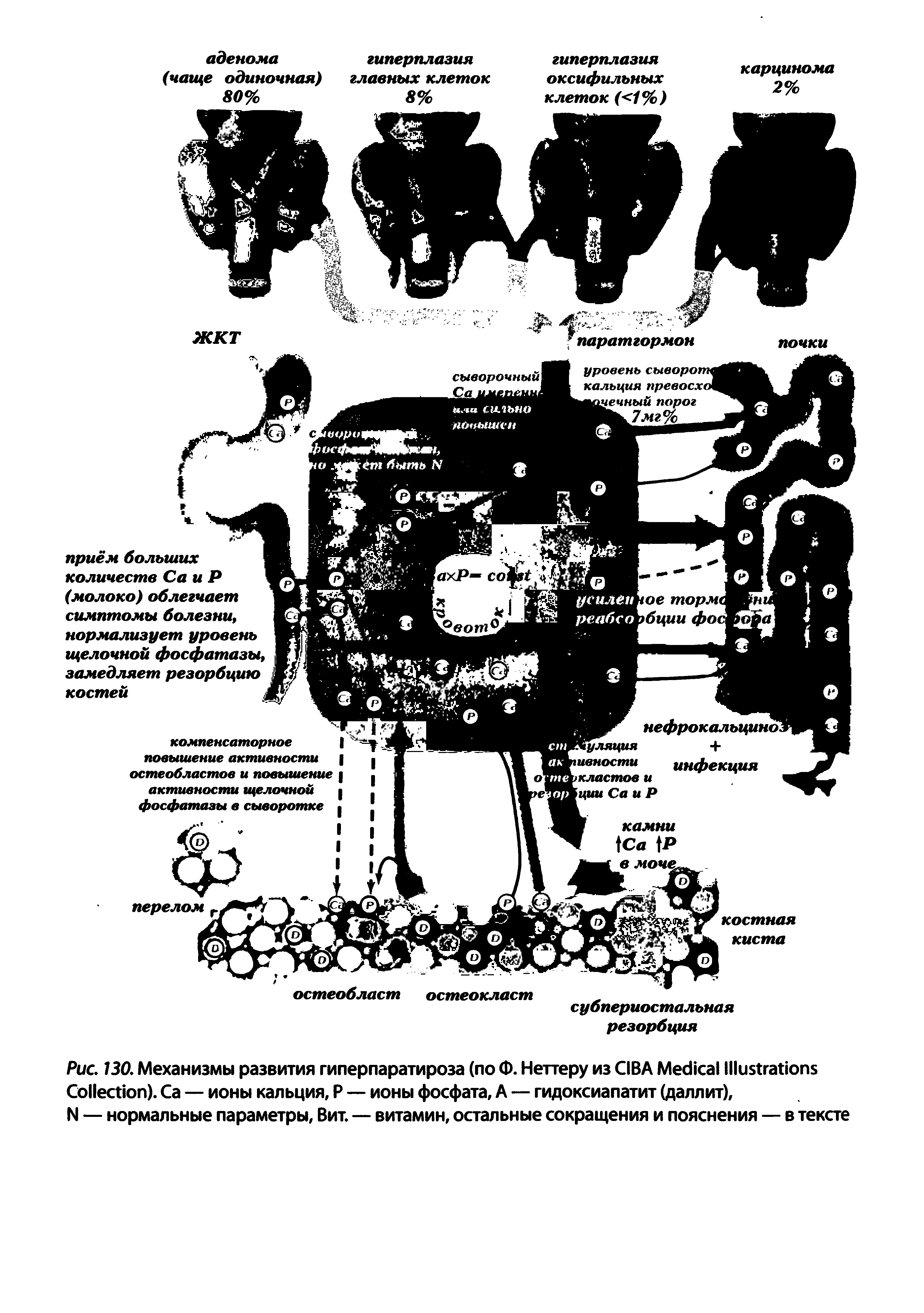 Рис. 130. Механизмы развития гиперпаратироза (по Ф. Неттеру из CIBA M I C ). Са — ионы кальция, Р — ионы фосфата, А — гидоксиапатит (даллит),...
