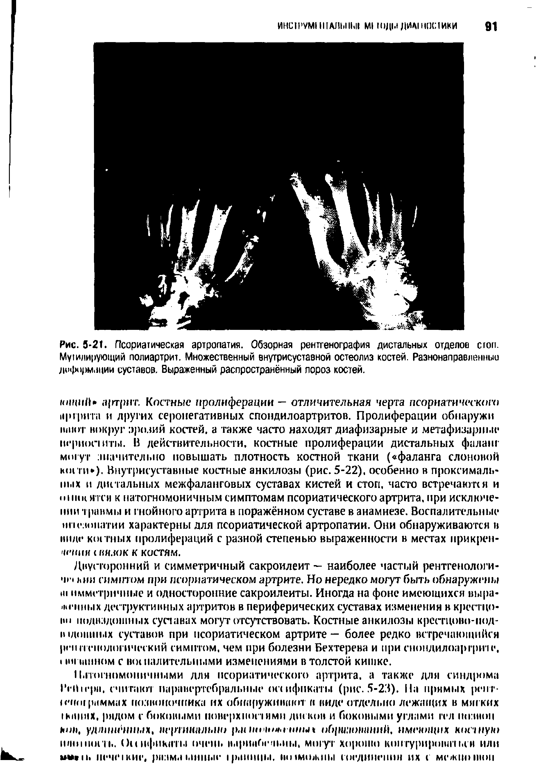 Рис. 5-21. Псориатическая артропатия. Обзорная рентгенография дистальных отделов стоп. Му1илирующий полиартрит. Множественный внутрисуставной остеолиз костей. Разнонаправленный д(к >ормации суставов. Выраженный распространённый пороз костей.