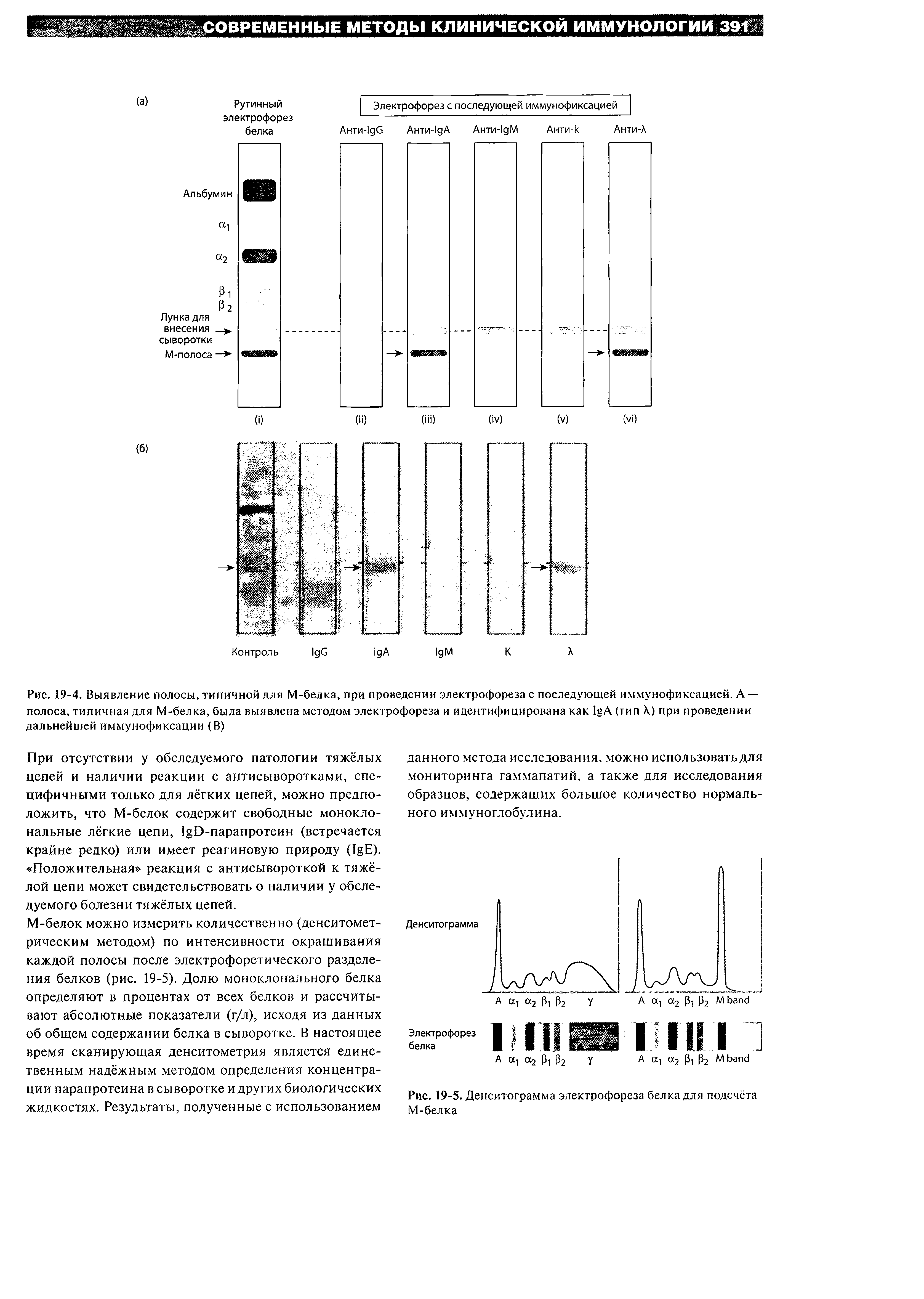 Рис. 19-4. Выявление полосы, типичной для М-белка, при проведении электрофореза с последующей им.мунофиксацией. А — полоса, типичная для М-белка, была выявлена методом электрофореза и идентифицирована как I A (тип X) при проведении дальнейшей иммунофиксации (В)...