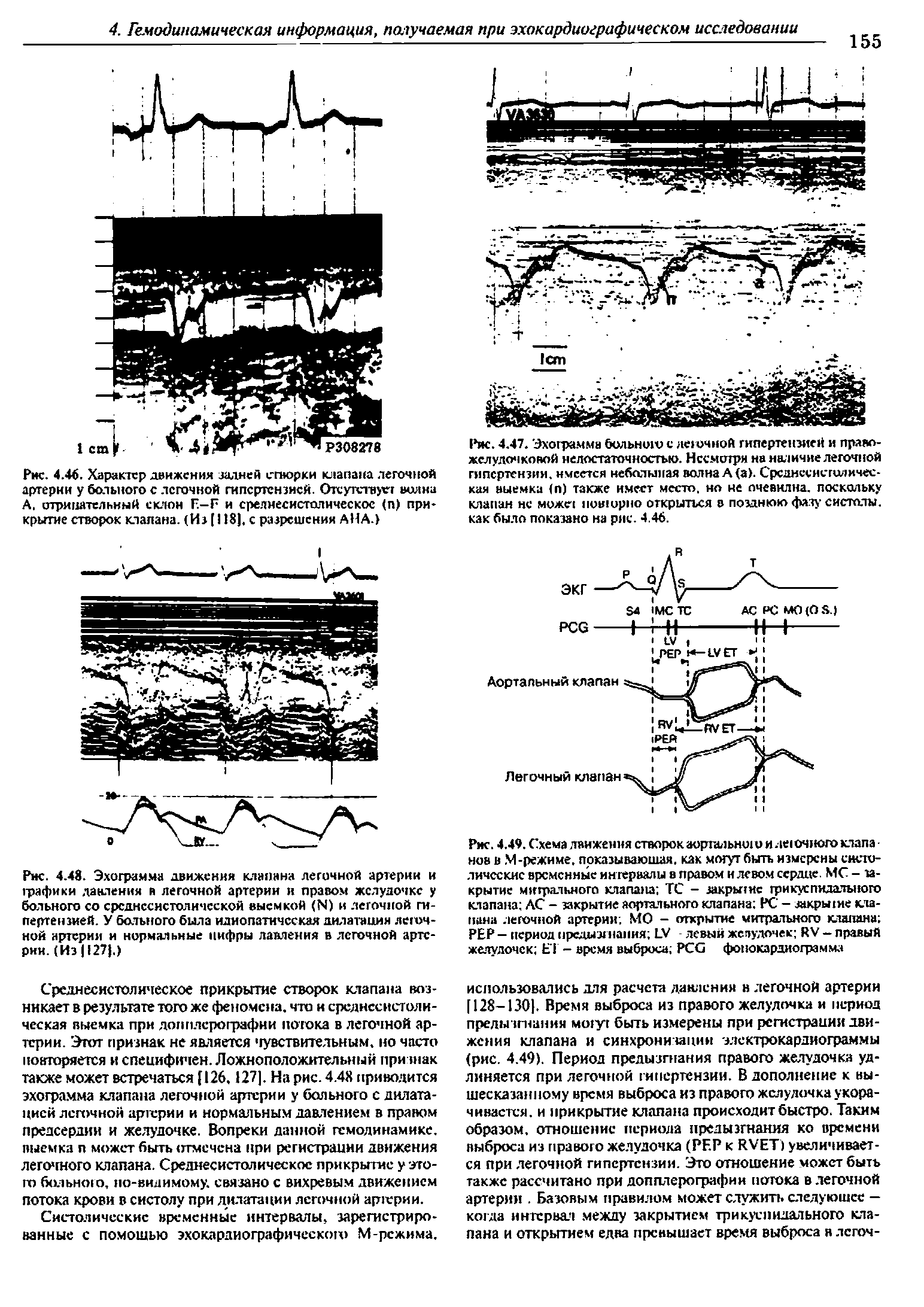Рис. 4.48. Эхограмма движения клапана легочной артерии и графики давления я легочной артерии и правом желудочке у больного со срсднссистолической выемкой (Ы) и легочной гипертензией. У больного била идиопатическая дилатация легочной артерия и нормальные цифры давления в легочной артерии. (Из 1127. )...