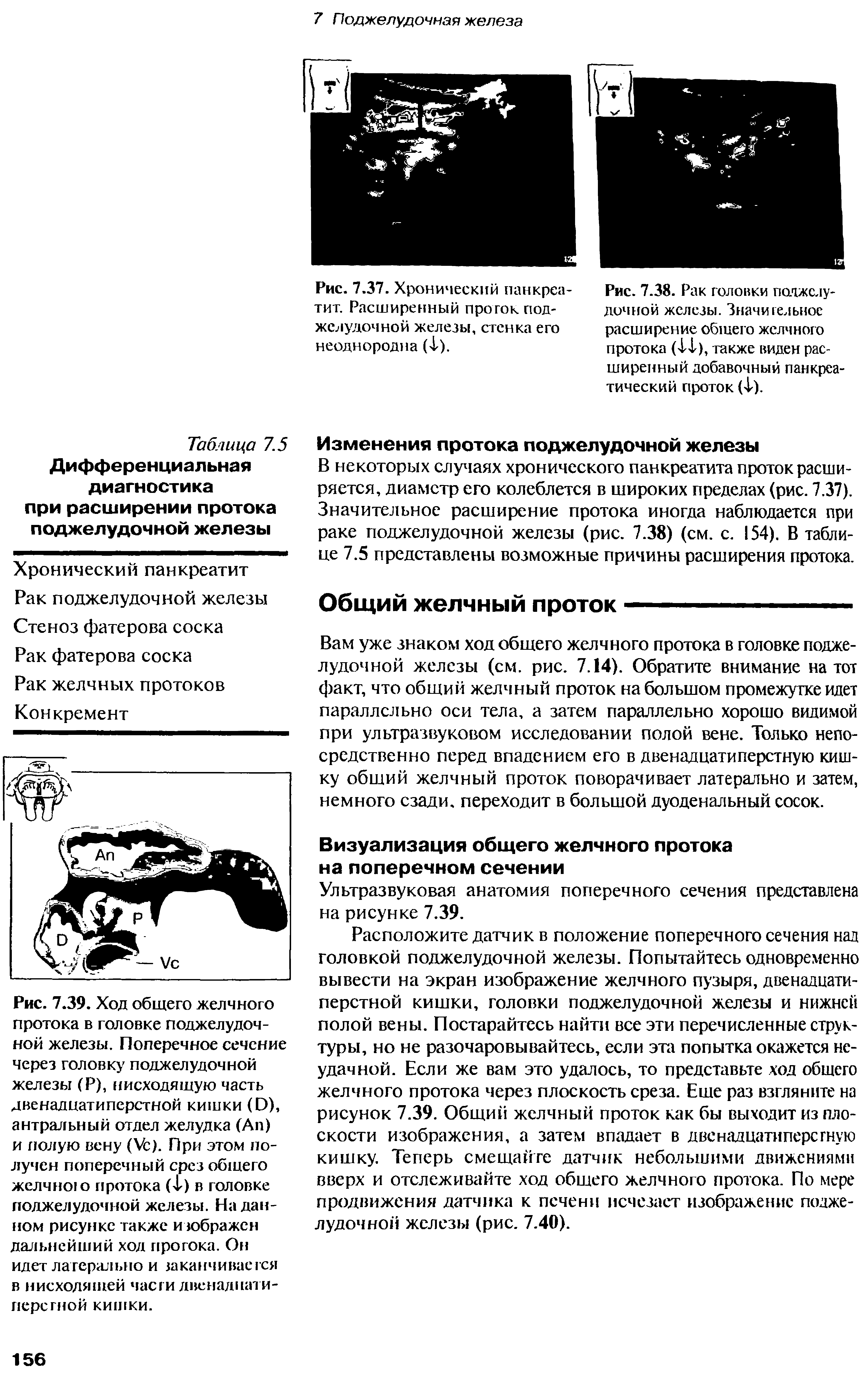 Рис. 7.38. Рак головки поджелудочной железы. Значительное расширение общего желчного протока (41), также виден расширенный добавочный панкреатический проток (4).