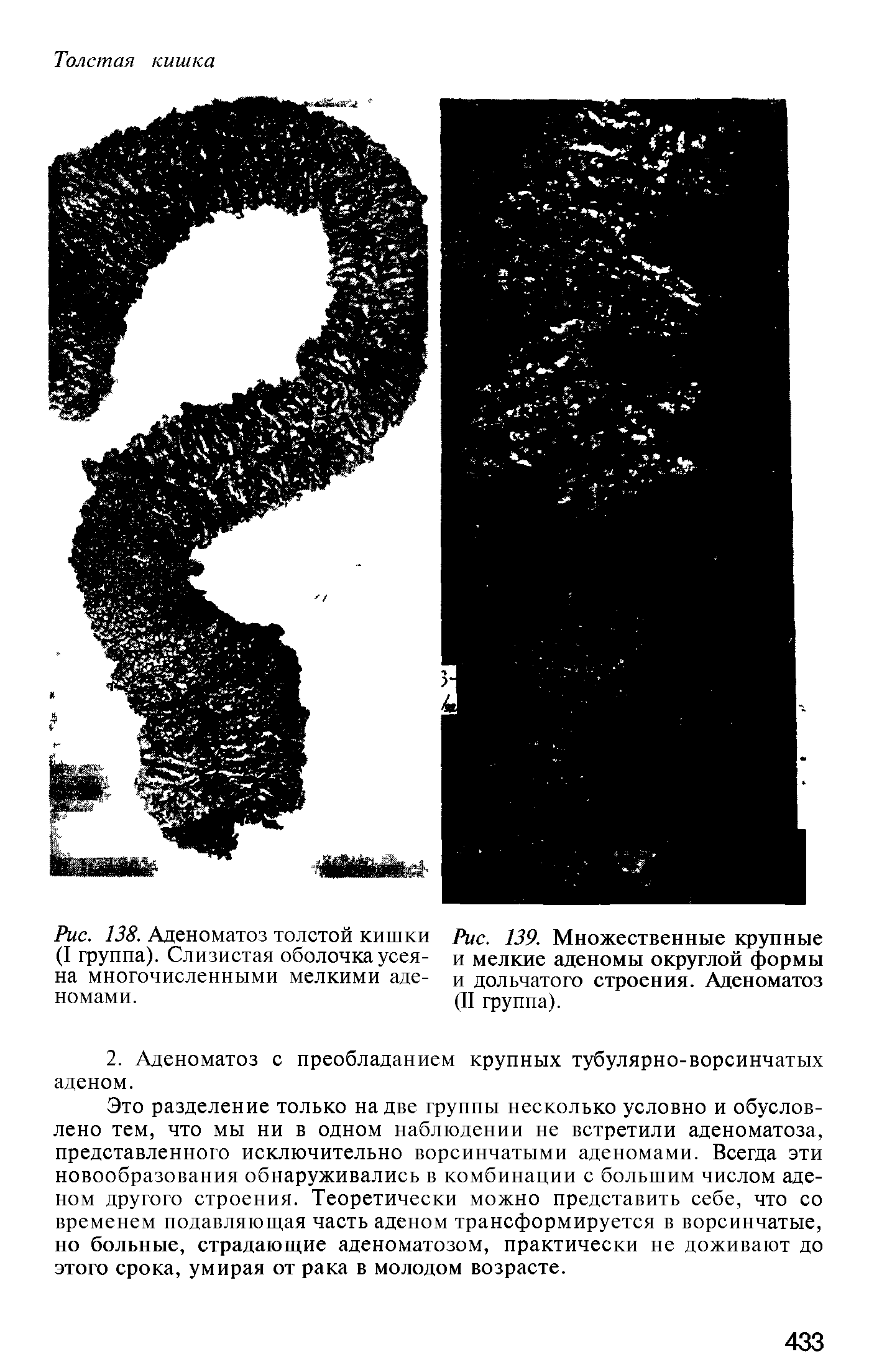 Рис. 138. Аденоматоз толстой кишки (I группа). Слизистая оболочка усеяна многочисленными мелкими аденомами.