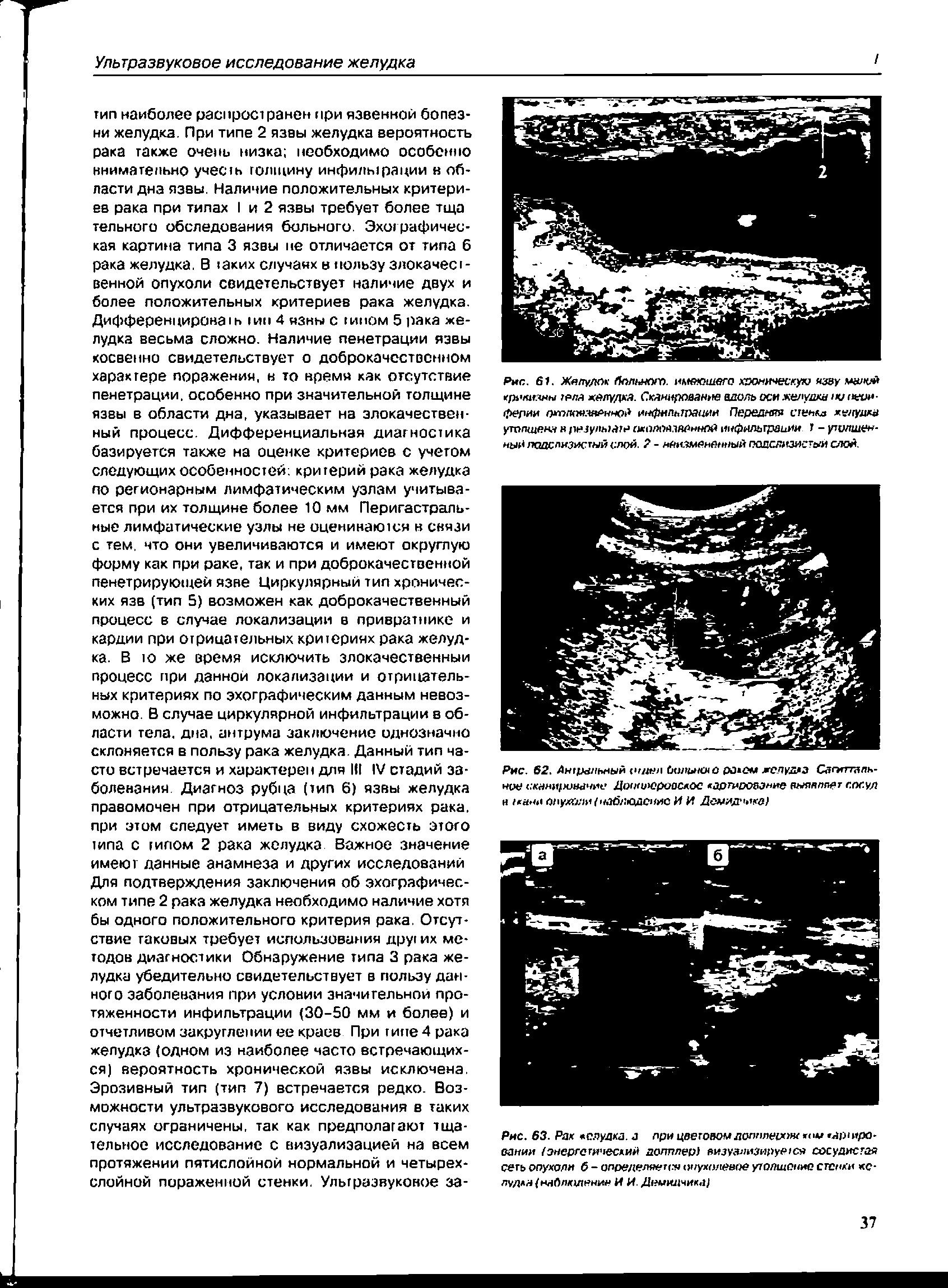 Рис. 63. Рак елудка. а при цветовом допплером ом ярн ро-оании /энергетический допплер) визуализируется сосудистая сеть опухоли б - определяется опухолевое утопшопис стенки ко-лудла/наблкитение И И. Димтщчика)...