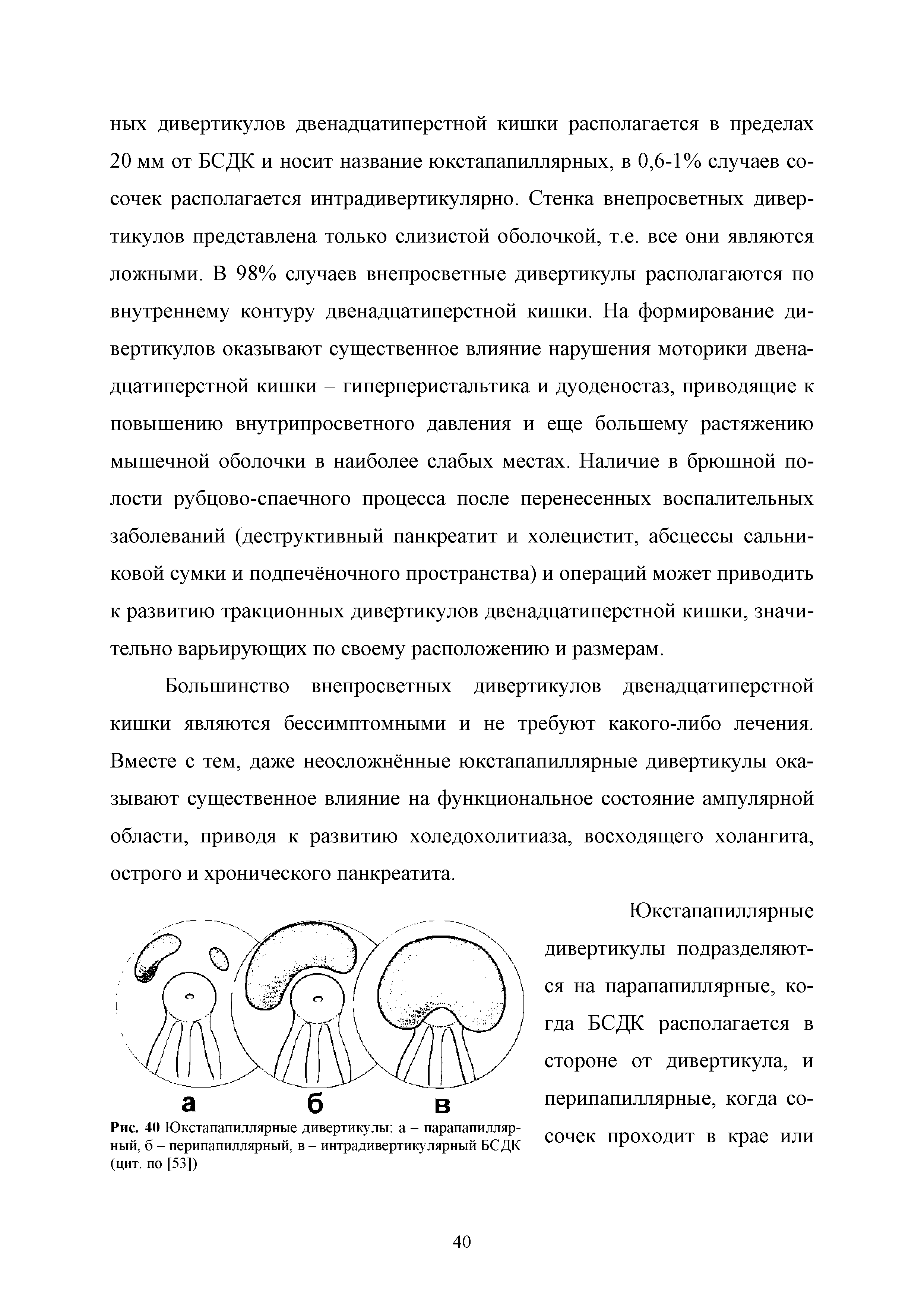 Рис. 40 Юкстапапиллярные дивертикулы а - парапапилляр-ный, б - перипапиллярный, в - интрадивертикулярный БСДК (цит. по [53])...