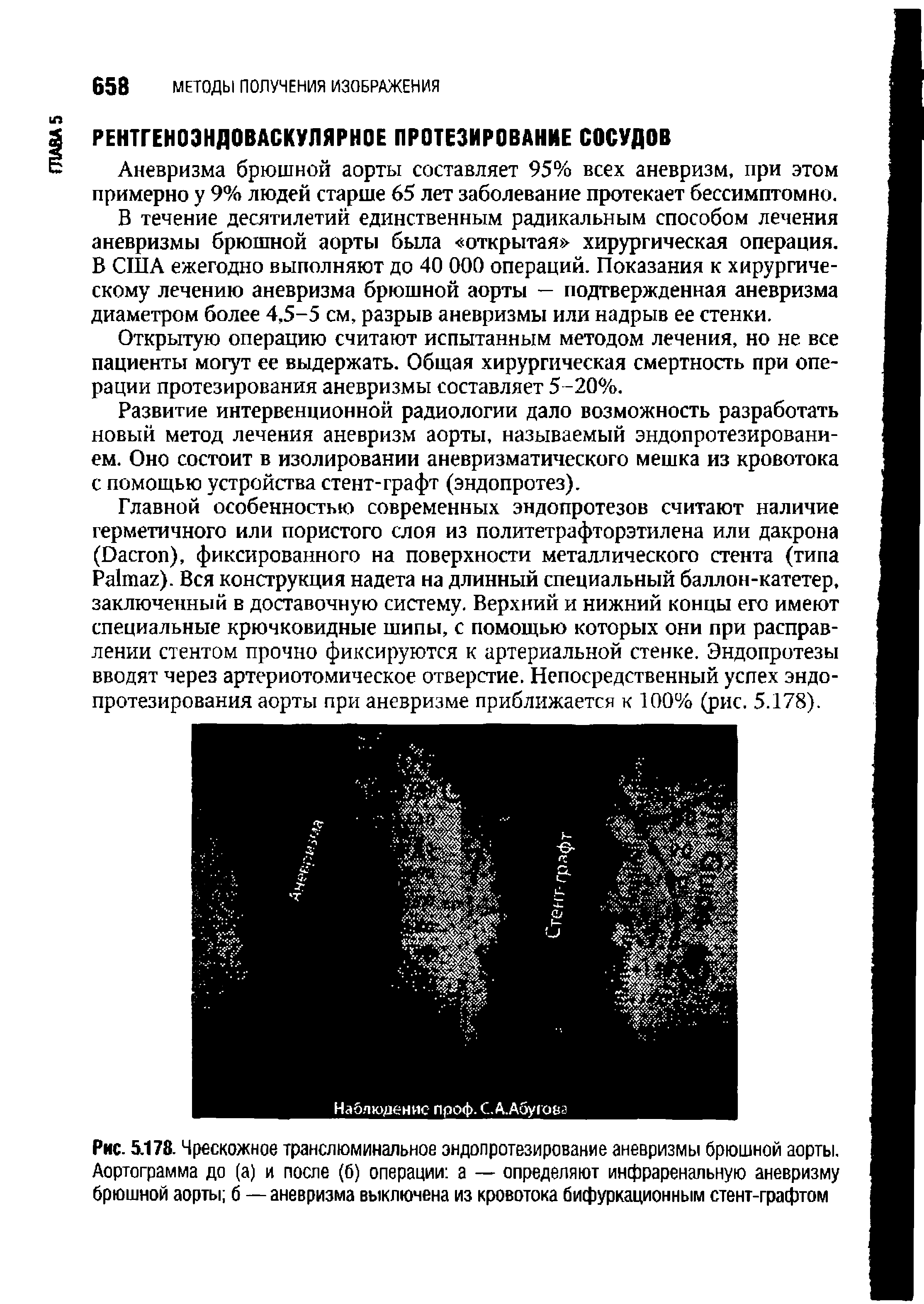 Рис. 5.178. Чрескожное транслюминальное эндопротезирование аневризмы брюшной аорты. Аортограмма до (а) и после (б) операции а — определяют инфраренальную аневризму брюшной аорты б — аневризма выключена из кровотока бифуркационным стент-графтом...