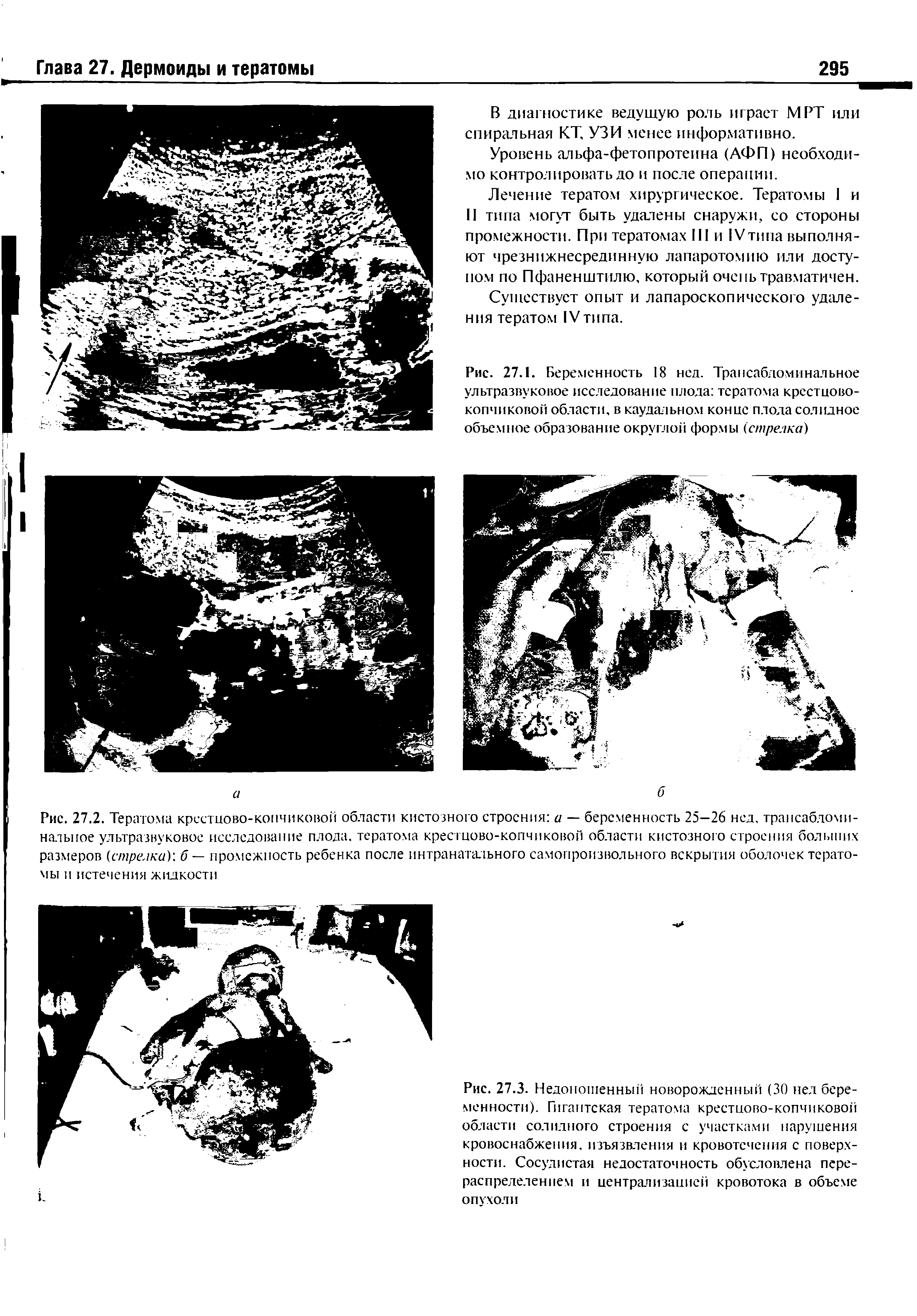 Рис. 27.3. Недоношенный новорожденный (30 пел беременности). Гигантская тератома крестцово-копчиковой области солидного строения с участками нарушения кровоснабжения, изъязвления и кровотечения с поверхности. Сосудистая недостаточность обусловлена перераспределением и централизацией кровотока в объеме опухоли...