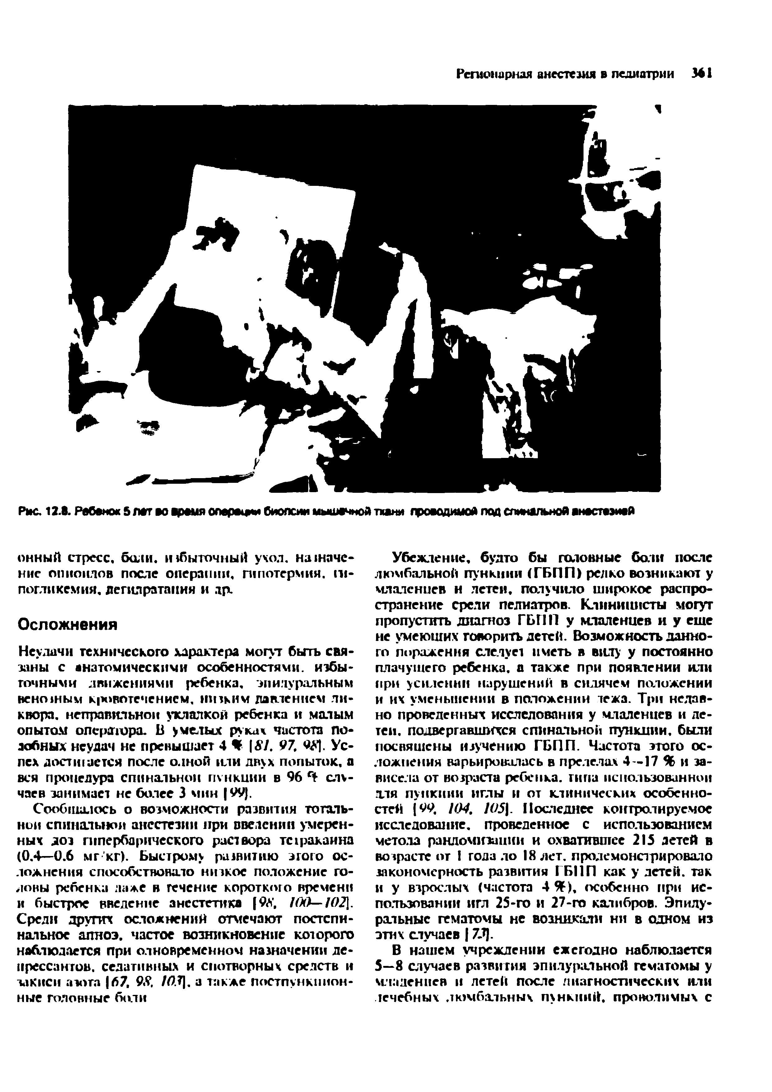 Рис. 12-8. Ребенок 5 лат во время операции биопсии мышечной ткани проводимой под спинальной анестезией...