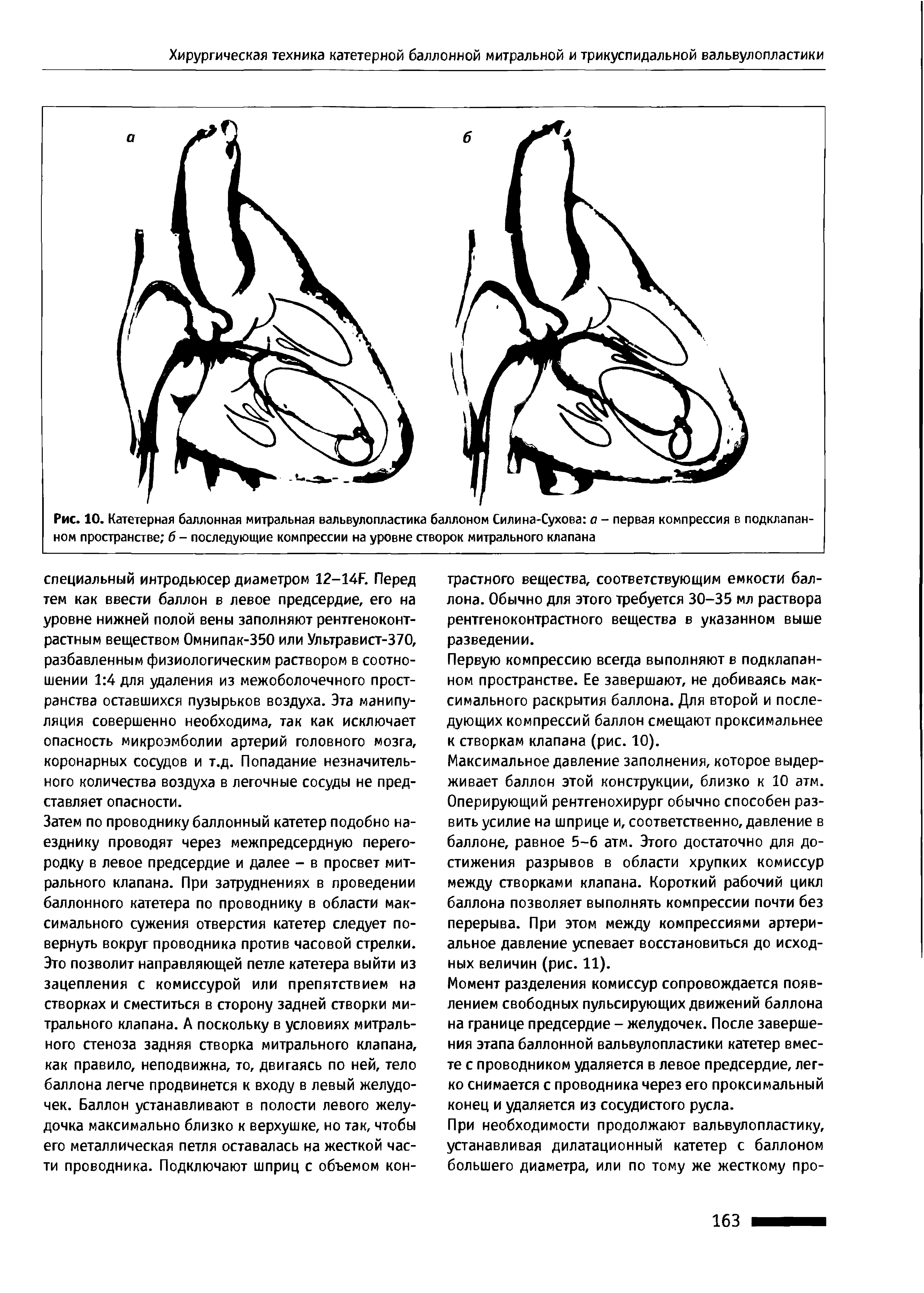 Рис. 10. Катетерная баллонная митральная вальвулопластика баллоном Силина-Сухова а - первая компрессия в подклапанном пространстве б - последующие компрессии на уровне створок митрального клапана...