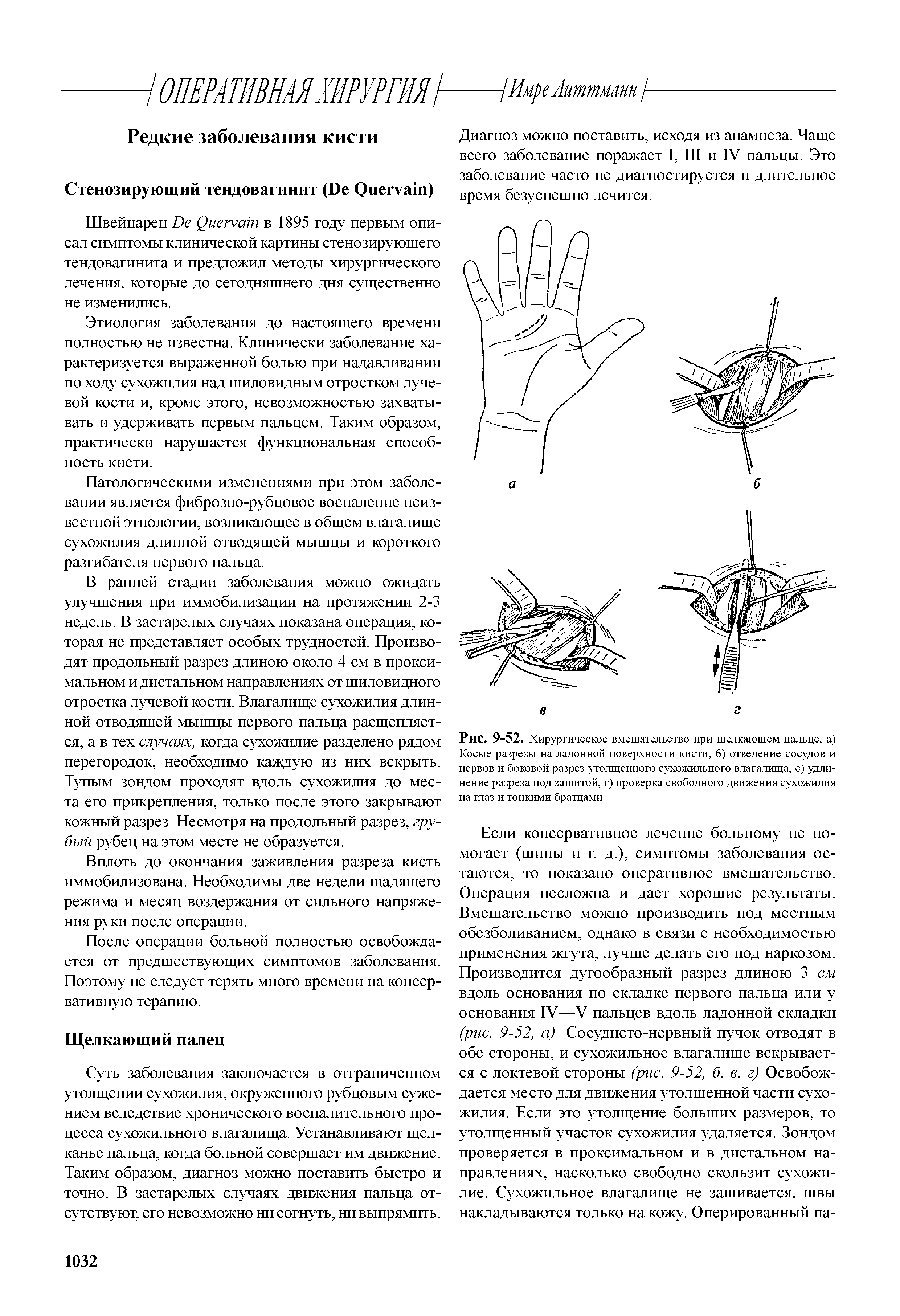 Рис. 9-52. Хирургическое вмешательство при щелкающем пальце, а) Косые разрезы на ладонной поверхности кисти, 6) отведение сосудов и нервов и боковой разрез утолщенного сухожильного влагалища, е) удлинение разреза под защитой, г) проверка свободного движения сухожилия на глаз и тонкими братцами...