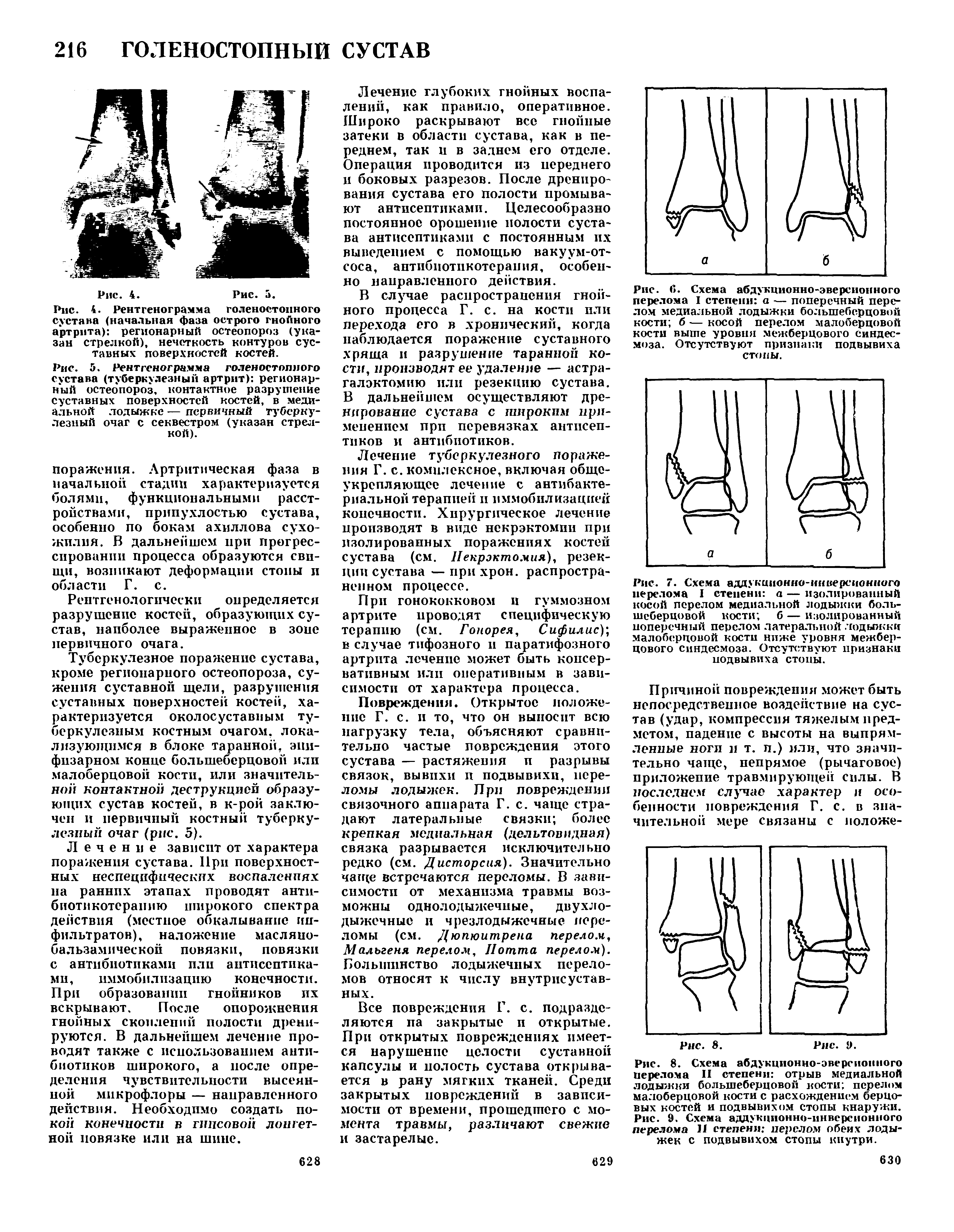 Рис. 5. Рентгенограмма голеностопного сустава (туберкулезный артрит) регионарный остеопороз, контактное разрушение суставных поверхностей костей, в медиальной лодыжке — первичный туберкулезный очаг с секвестром (указан стрелкой).