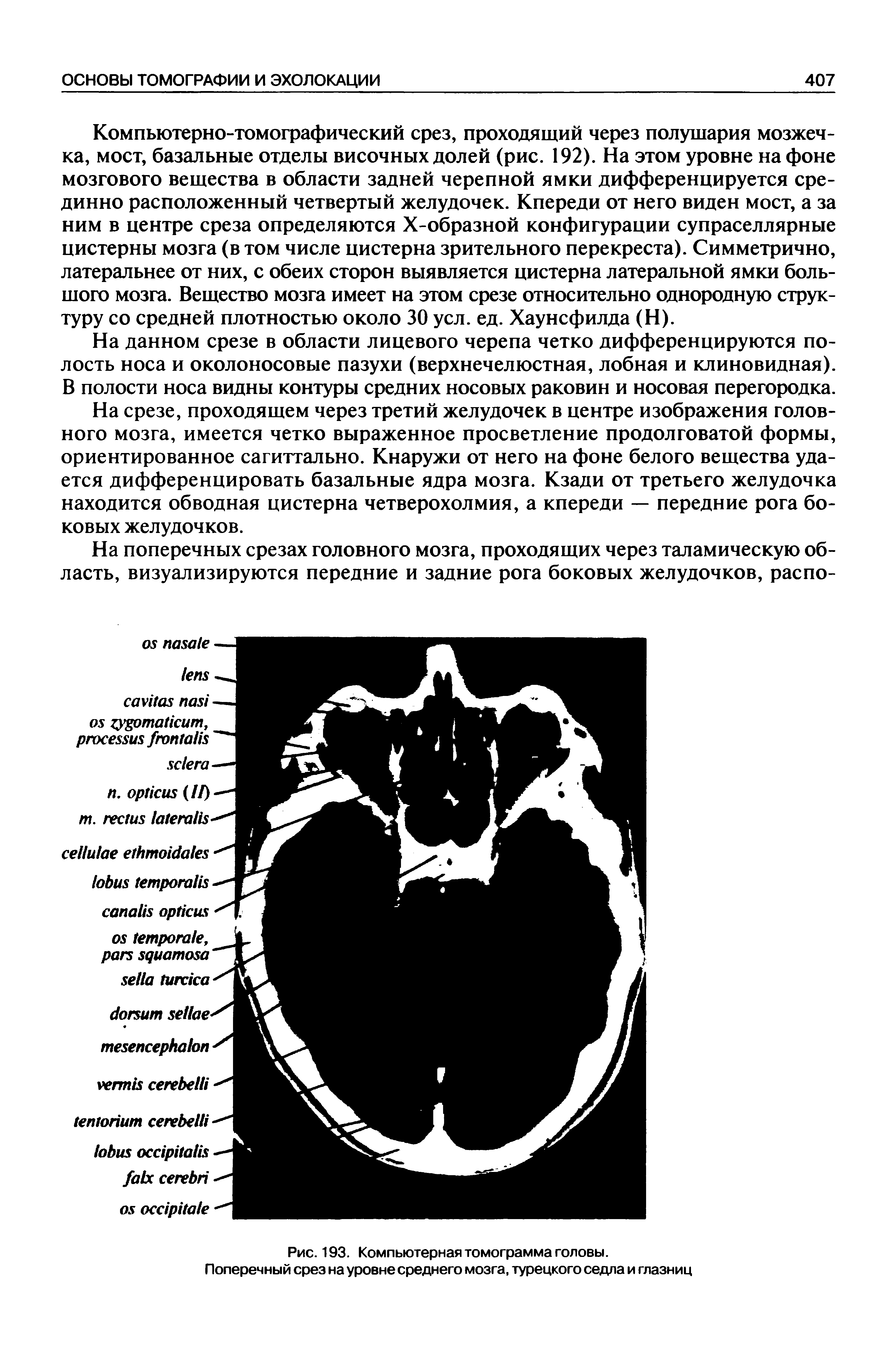 Рис. 193. Компьютерная томограмма головы. Поперечный срез на уровне среднего мозга, турецкого седла и глазниц...