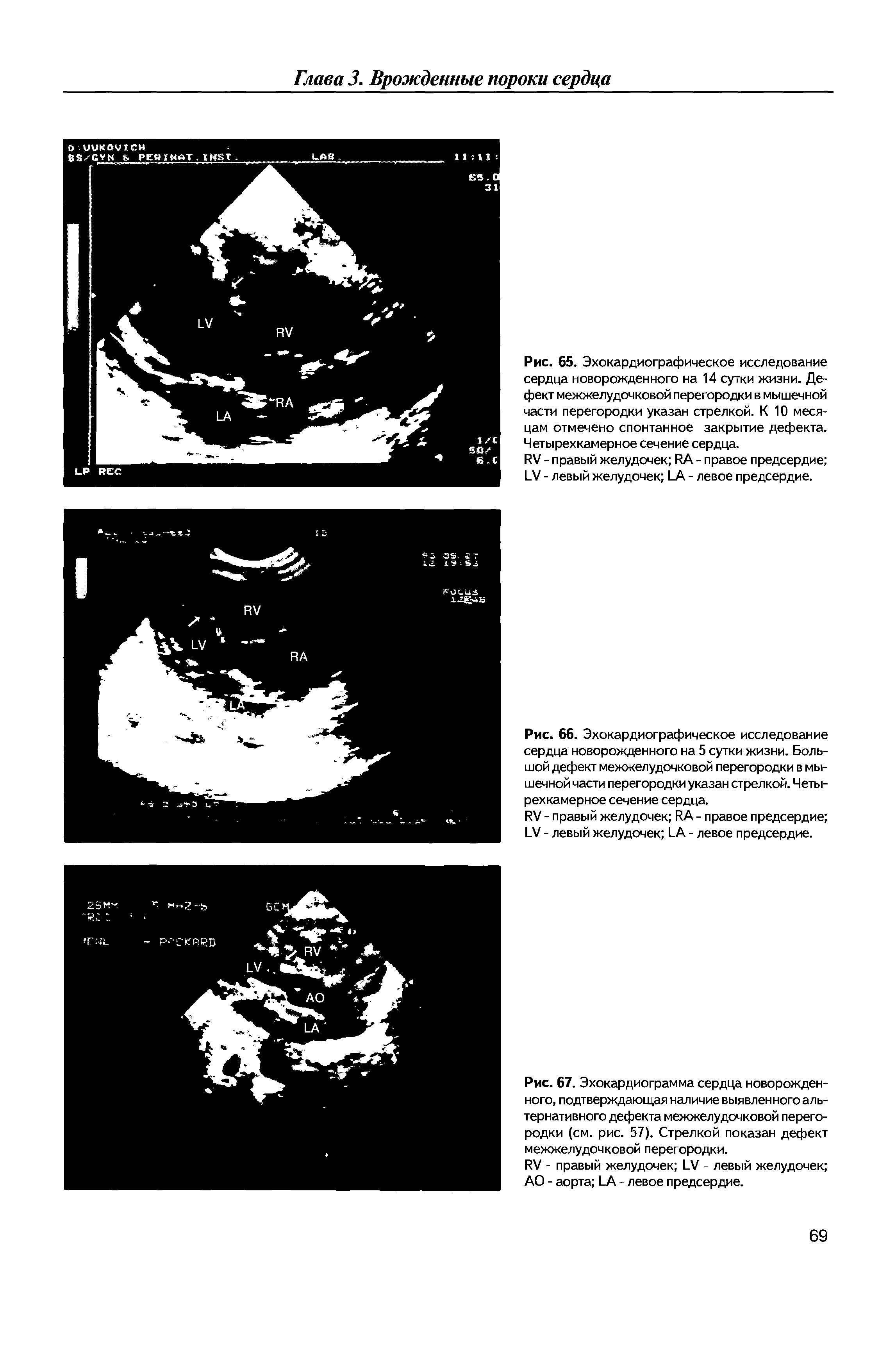 Рис. 65. Эхокардиографическое исследование сердца новорожденного на 14 сутки жизни. Дефект межжелудочковой перегородки в мышечной части перегородки указан стрелкой. К 10 месяцам отмечено спонтанное закрытие дефекта. Четырехкамерное сечение сердца.
