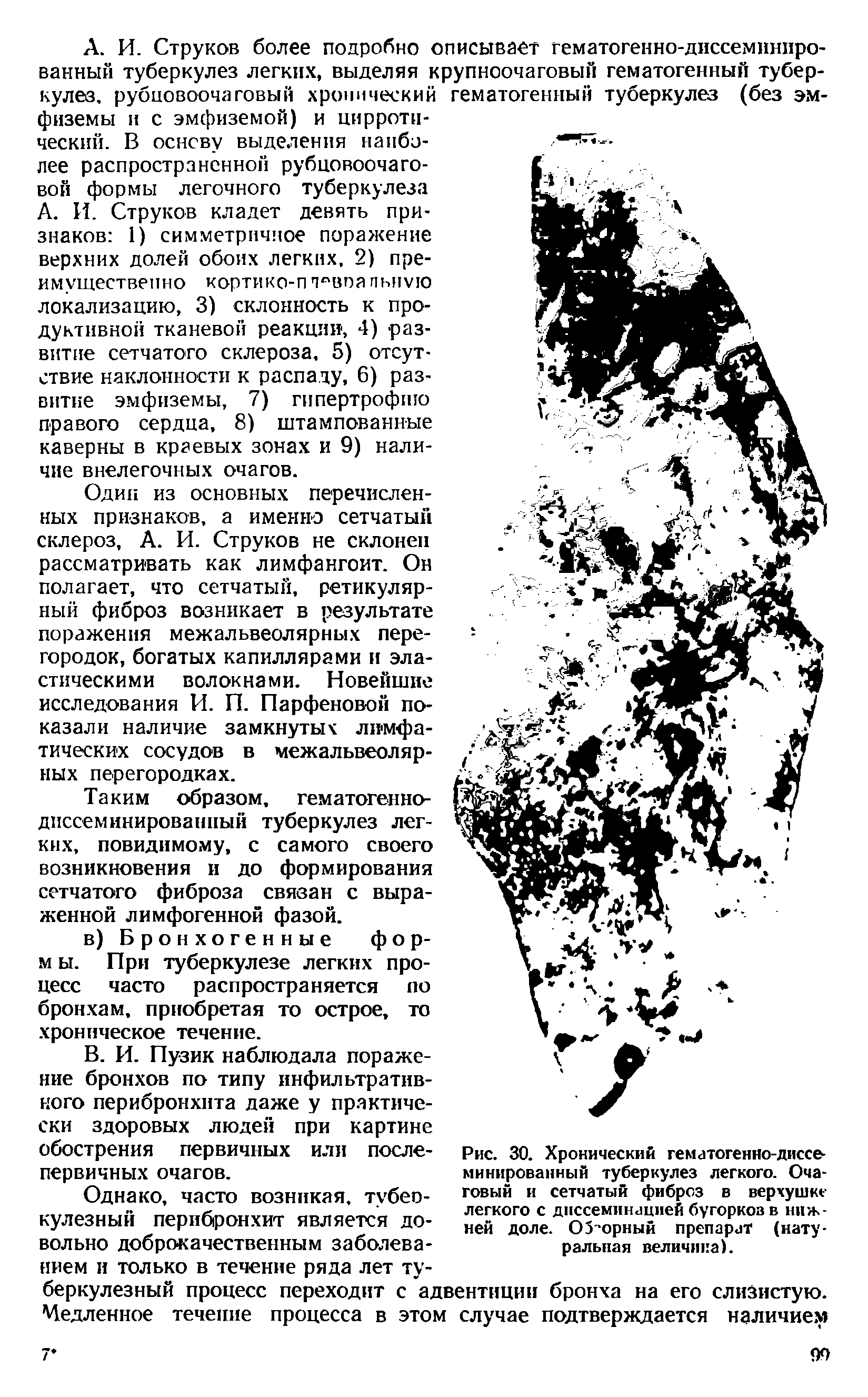 Рис. 30. Хронический гематогенио-диссе-минированный туберкулез легкого. Очаговый и сетчатый фиброз в верхушке легкого с диссеминацией бугорков в нижней доле. О5-орный препарат (натуральная величина).