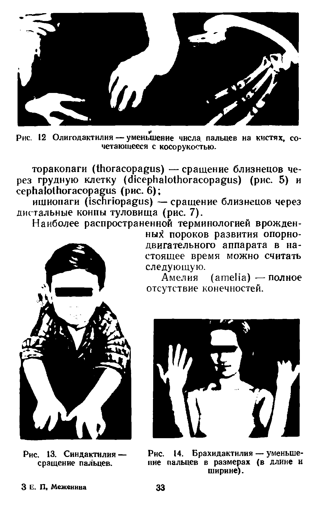 Рис. 12 Олигодактилия — уменьшение числа, пальцев на кистях, сочетающееся с косорукостью.