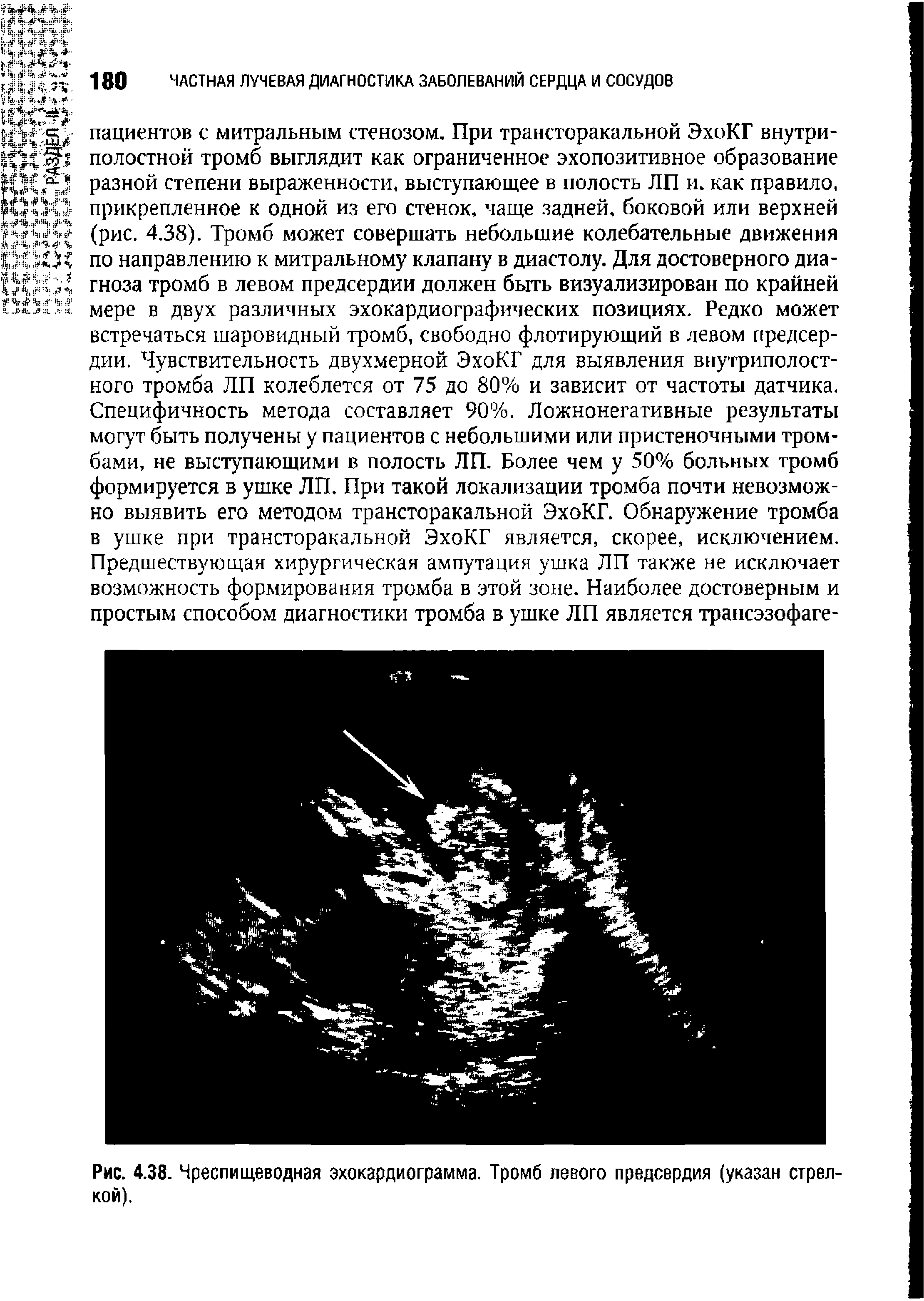 Рис. 4.38. Чреспищеводная эхокардиограмма. Тромб левого предсердия (указан стрелкой).