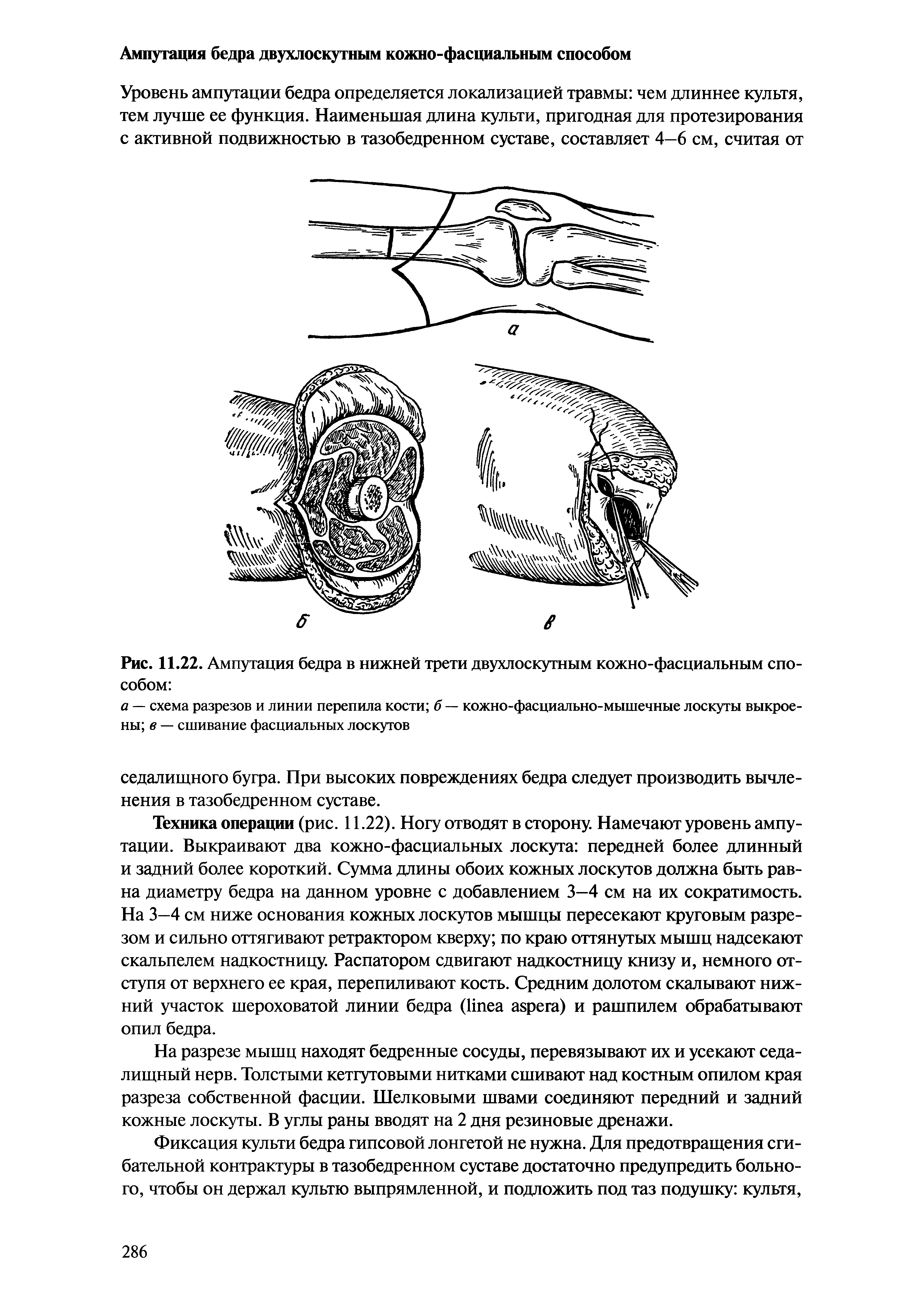 Рис. 11.22. Ампутация бедра в нижней трети двухлоскутным кожно-фасциальным способом ...