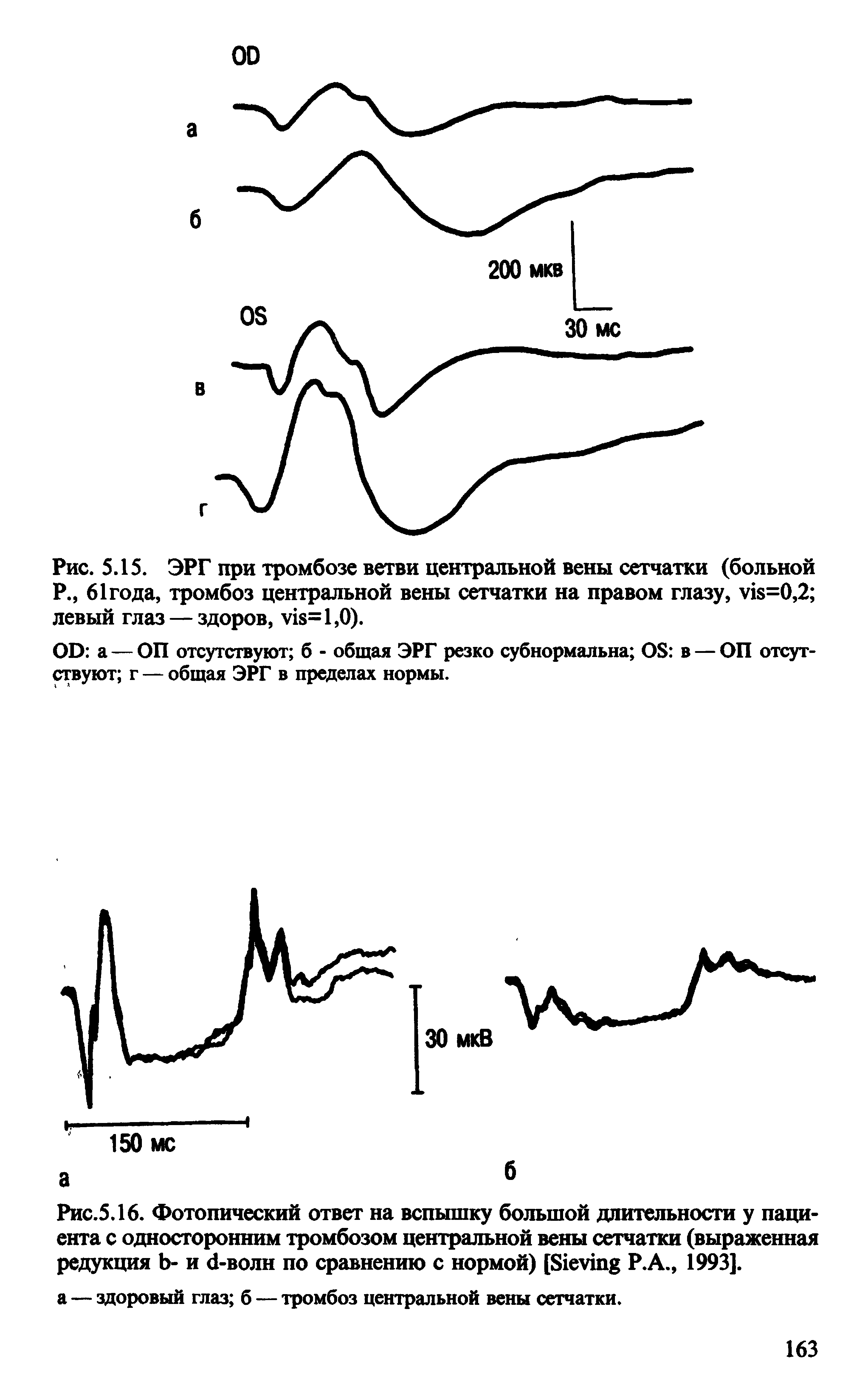 Рис. 5.15. ЭРГ при тромбозе ветви центральной вены сетчатки (больной Р., 61 года, тромбоз центральной вены сетчатки на правом глазу, у1 =0,2 левый глаз — здоров, у18=1,0).