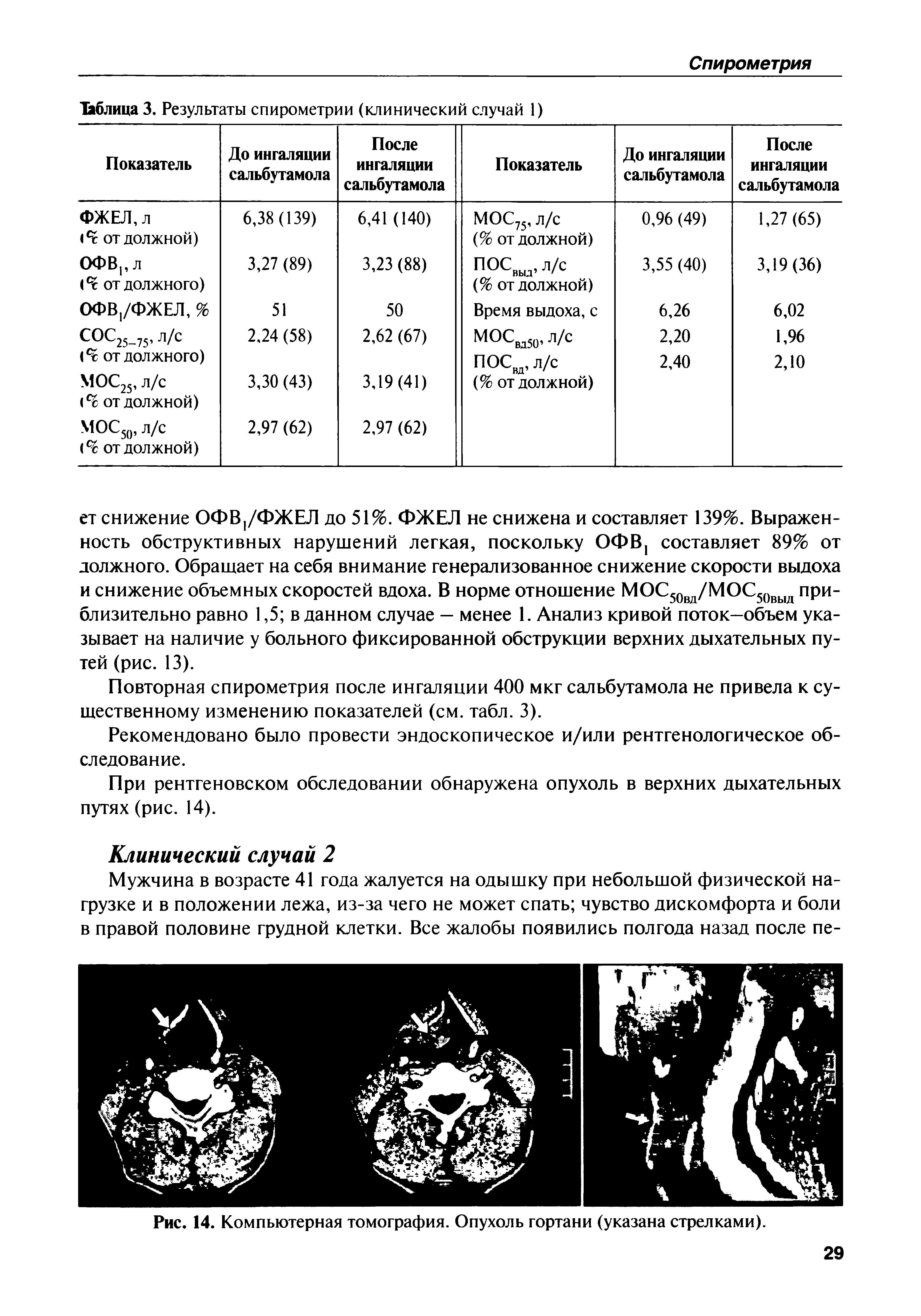 Рис. 14. Компьютерная томография. Опухоль гортани (указана стрелками).