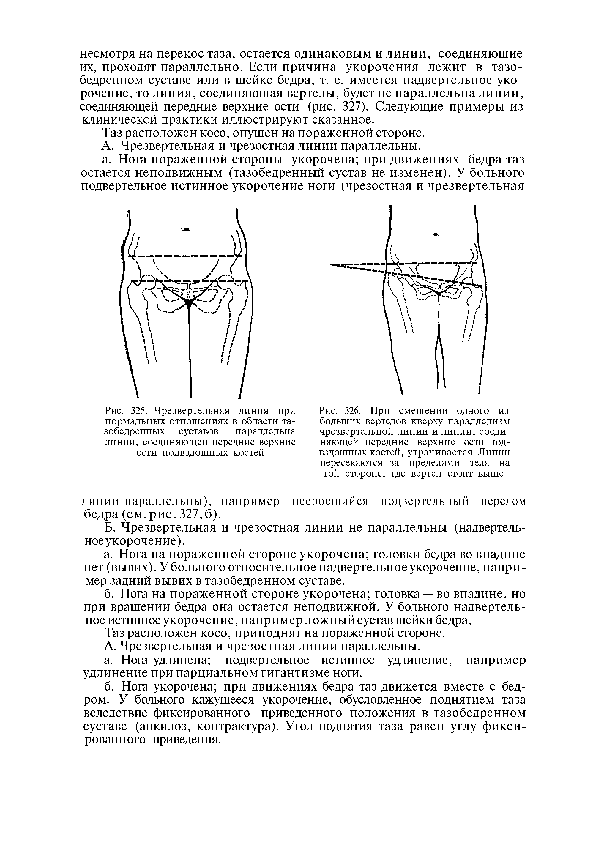 Рис. 325. Чрезвертельная линия при нормальных отношениях в области тазобедренных суставов параллельна линии, соединяющей передние верхние ости подвздошных костей...