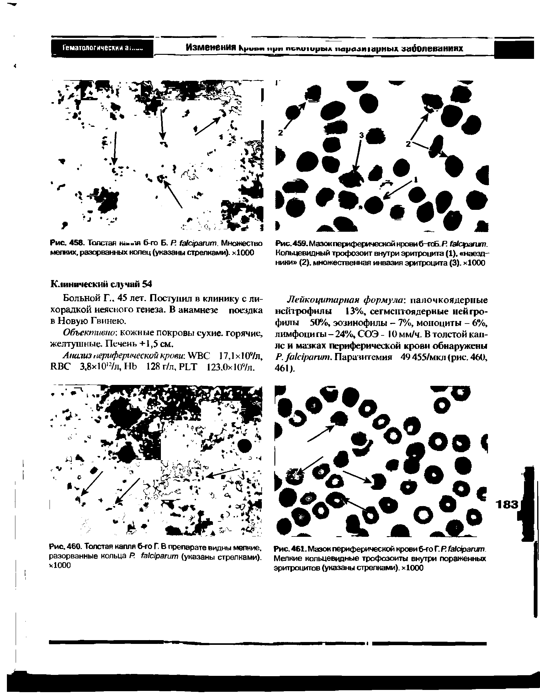 Рис.459.Мазокпериферическойкровиб-тоБ.Я кфагит. Кольцевидный трофозоит внутри эритроцита (1), наездники (2). множественная инвазия эритроцита (3). х1000...