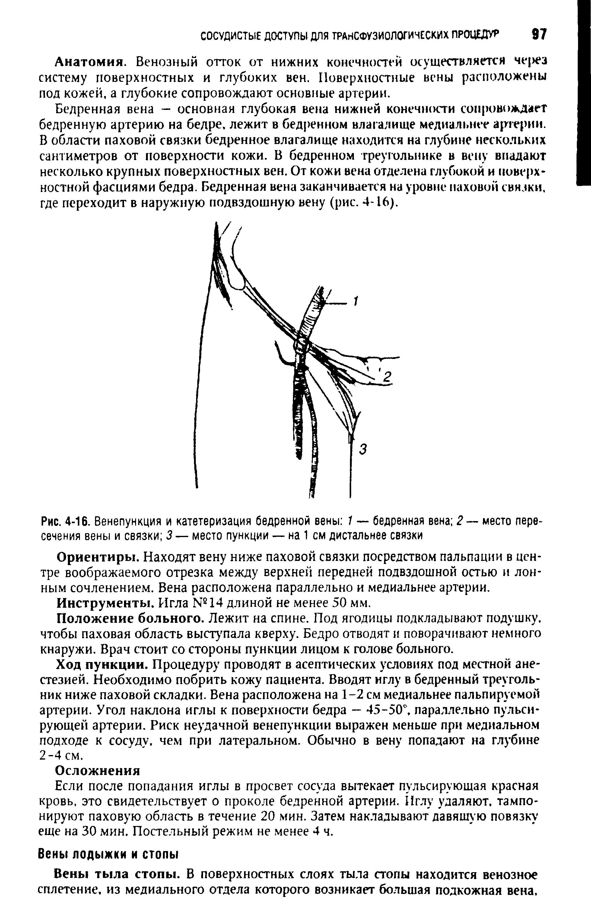 Рис. 4-16. Венепункция и катетеризация бедренной вены 1 — бедренная вена 2 — место пересечения вены и связки 3 — место пункции — на 1 см дистальнее связки...