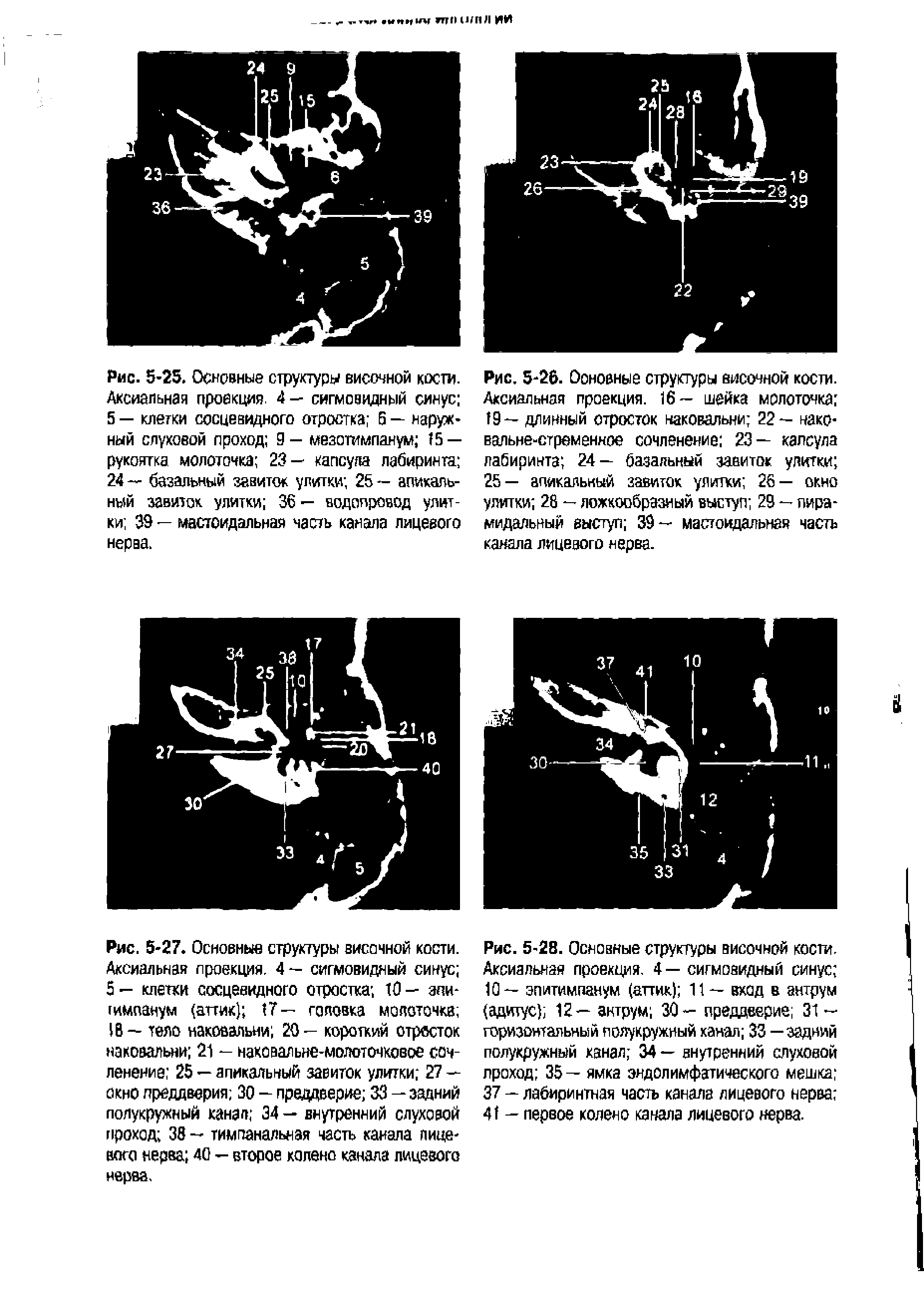 Рис. 5-25. Основные структуры височной кости. Аксиальная проекция. 4— сигмовидный синус 5 — клетки сосцевидного отростка 5 — наружный слуховой проход 9— мезотимпанум 15 — рукоятка молоточка 23— капсула лабиринта 24— базальный завиток улитки 25— апикальный завиток улитки 36 — водопровод улитки 39 — мастоидальная часть канала лицевого нерва.