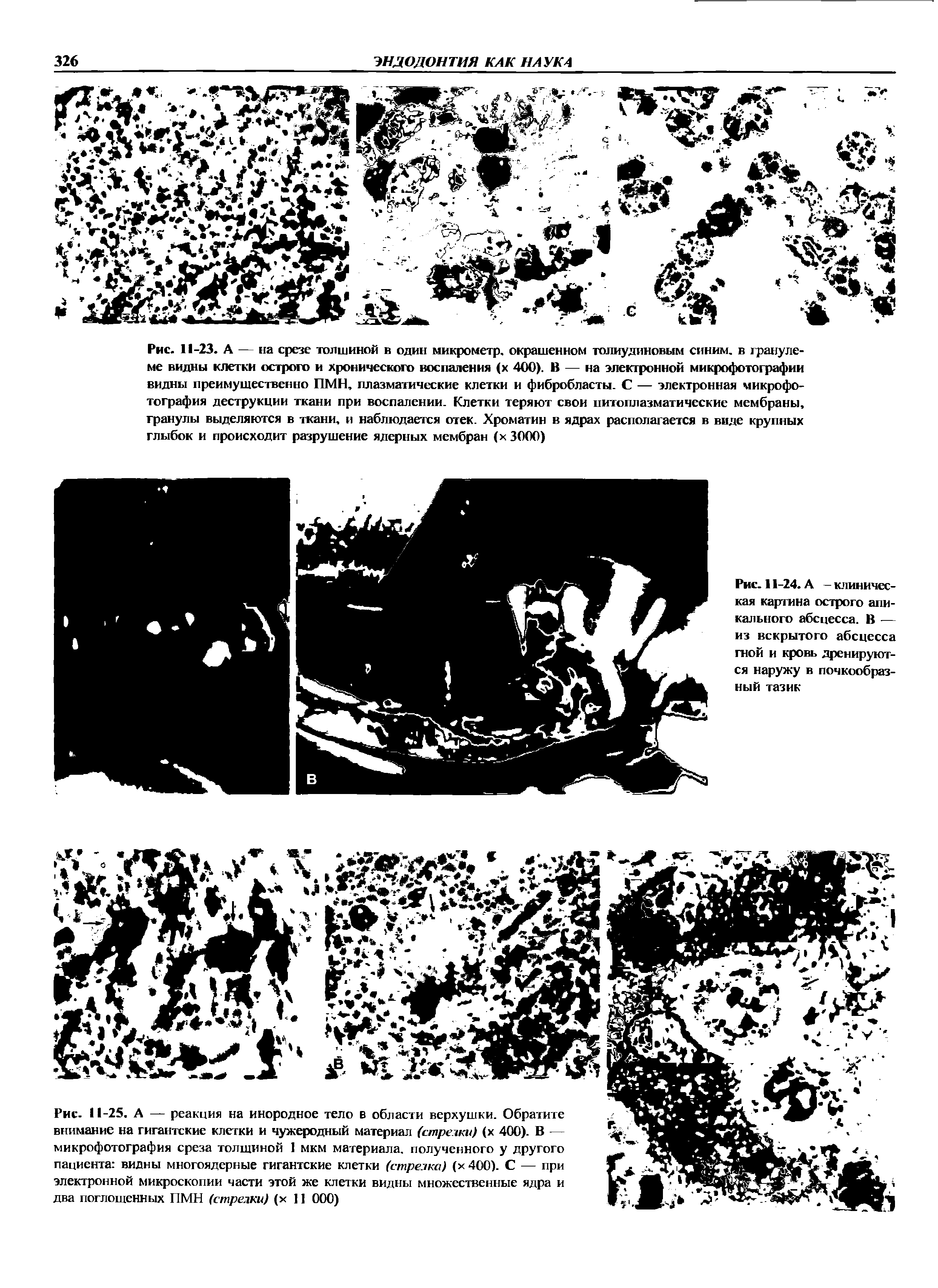 Рис. 11-24. А - клиническая картина острого апикального абсцесса. В — из вскрытого абсцесса гной и кровь дренируются наружу в почкообразный тазик...