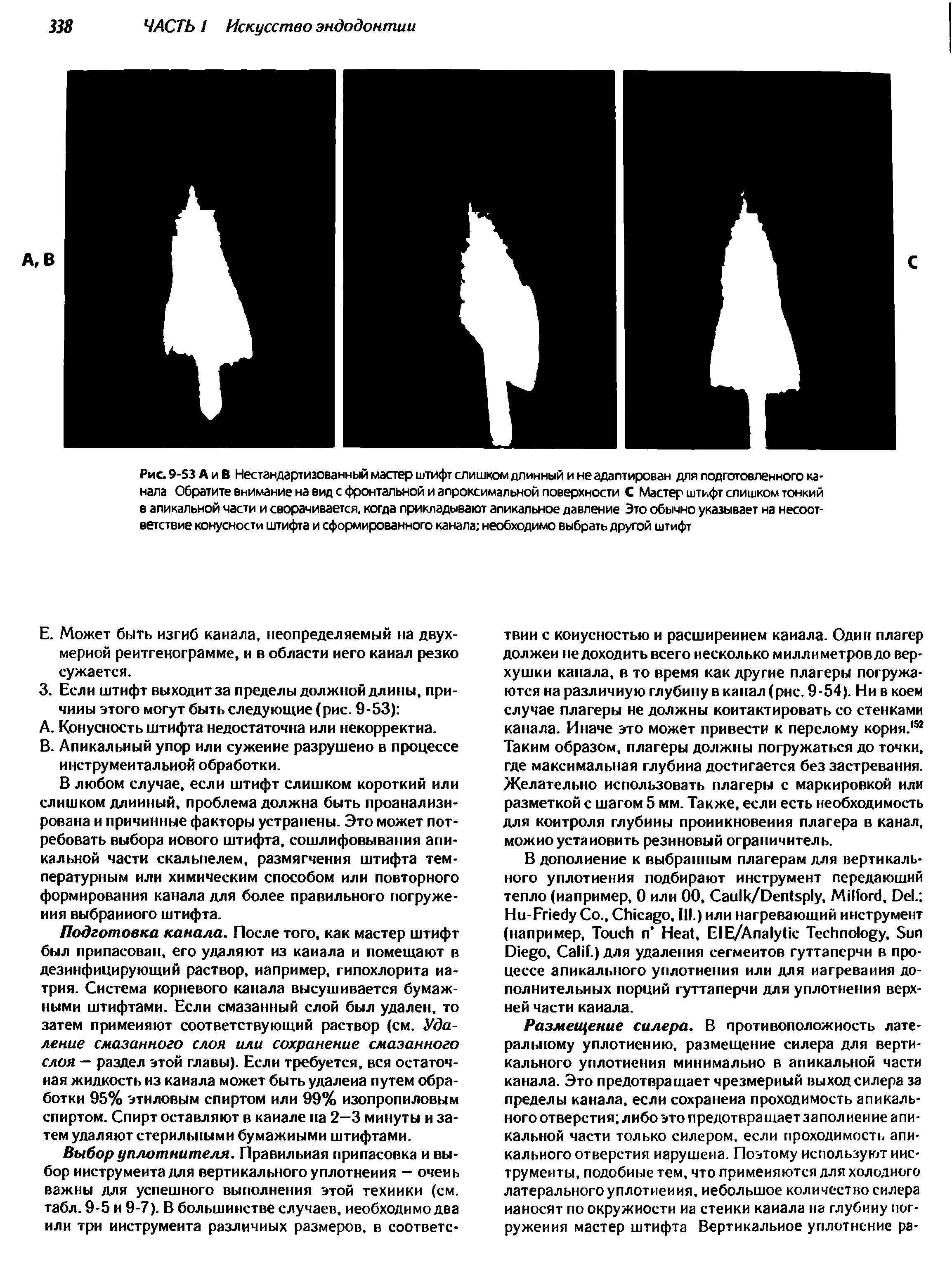 Рис. 9-53 А и В Нестандартизованный мастер штифт слишком длинный и не адаптирован для подготовленного канала Обратите внимание на вид с фронтальной и апроксимальной поверхности С Мастер штифт слишком тонкий в апикальной части и сворачивается, когда прикладывают апикальное давление Это обычно указывает на несоответствие конусности штифта и сформированного канала необходимо выбрать другой штифт...