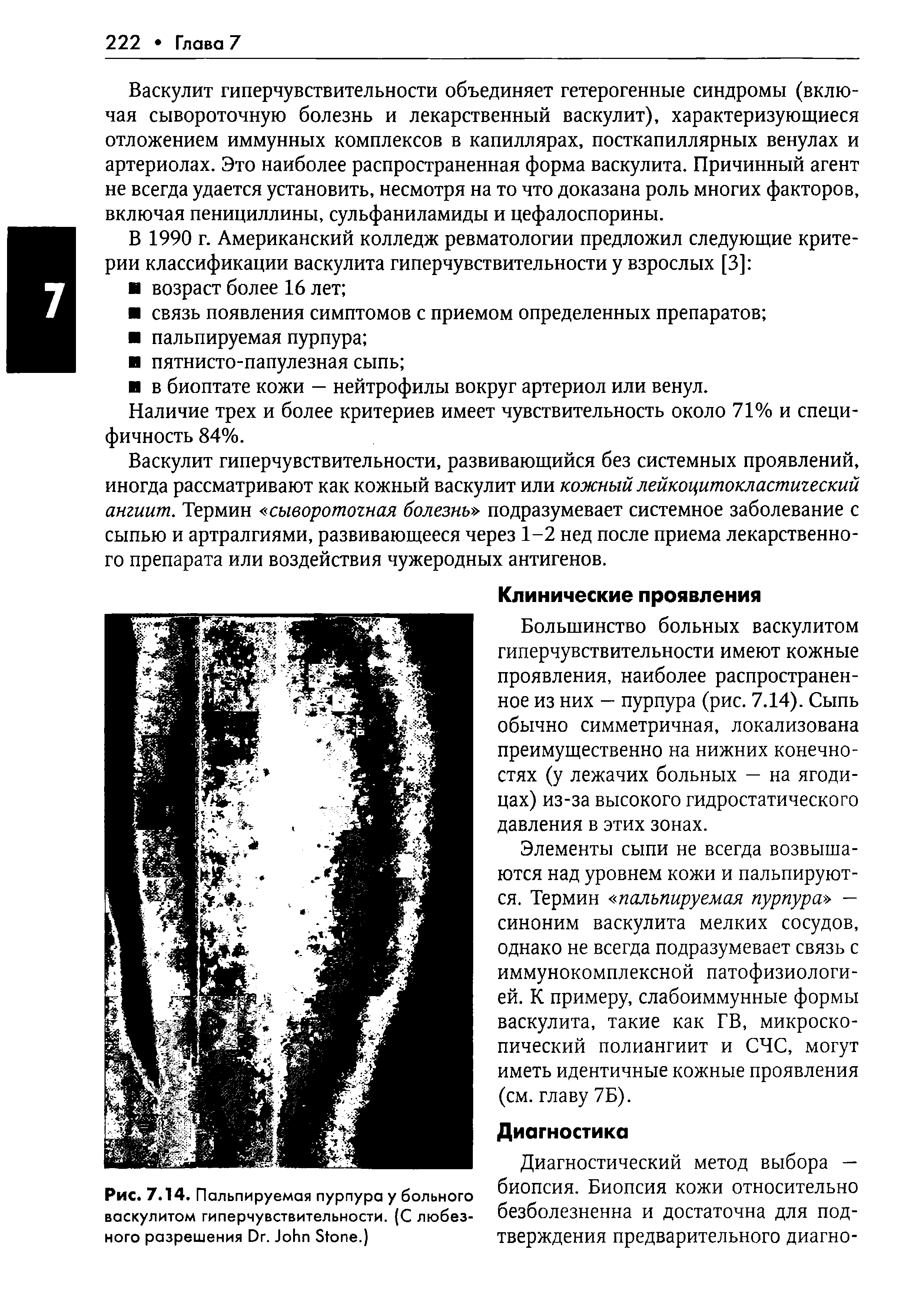 Рис. 7.14. Пальпируемая пурпура у больного васкулитом гиперчувствительности. (С любезного разрешения D . J S .)...