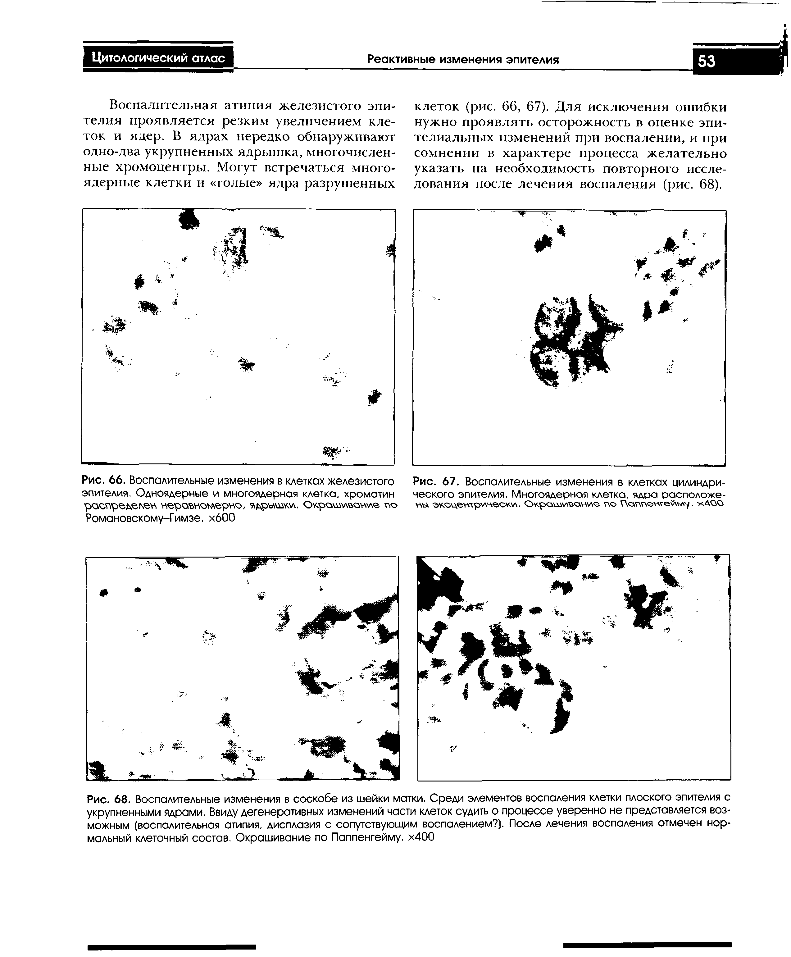 Рис. 66. Воспалительные изменения в клетках железистого эпителия. Одноядерные и многоядерная клетка, хроматин распределен неравноллернс, ядръ шки. Окрашивание по Романовскому-Гимзе. хбОО...