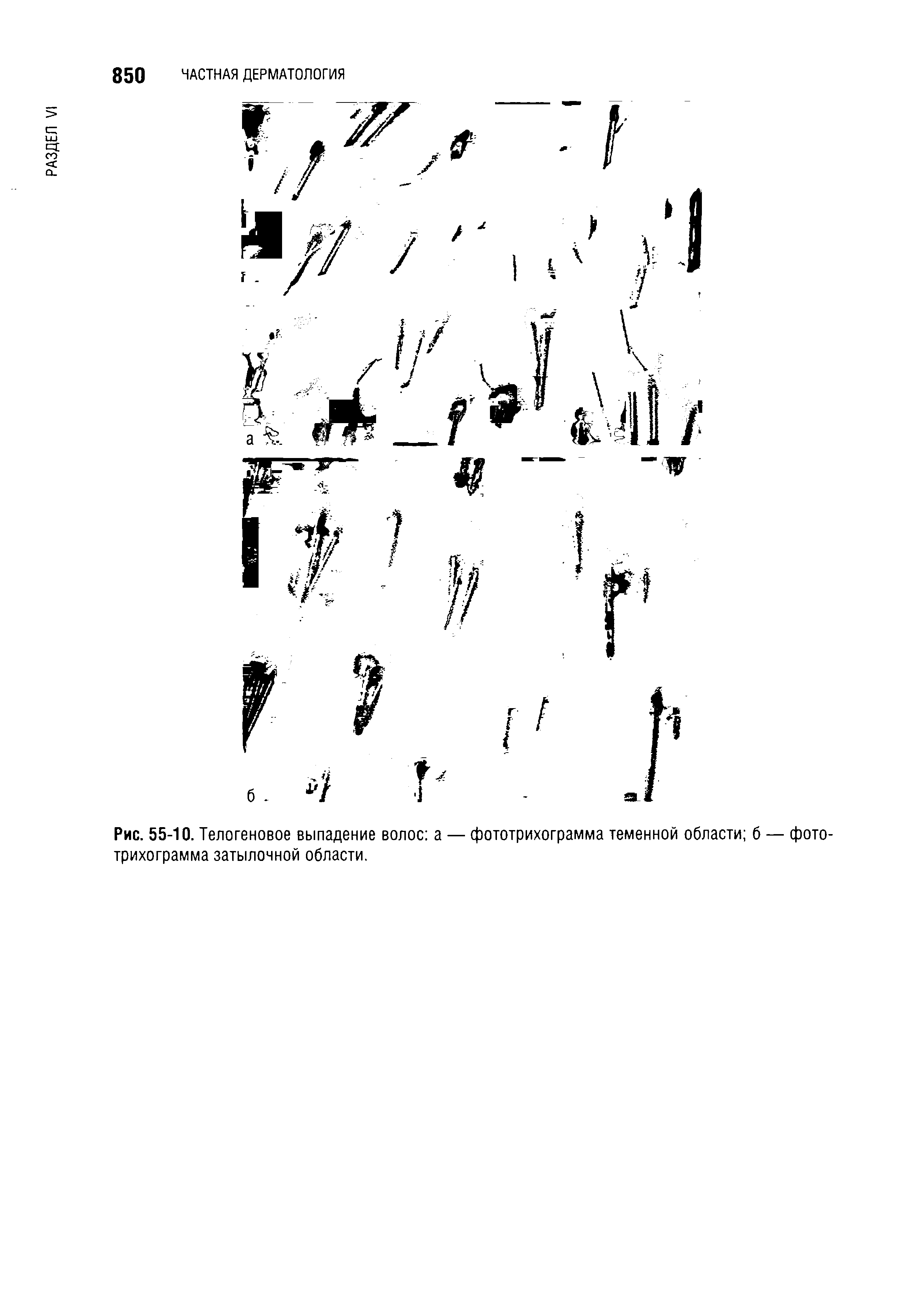 Рис. 55-10. Телогеновое выпадение волос а — фототрихограмма теменной области б — фото-трихограмма затылочной области.