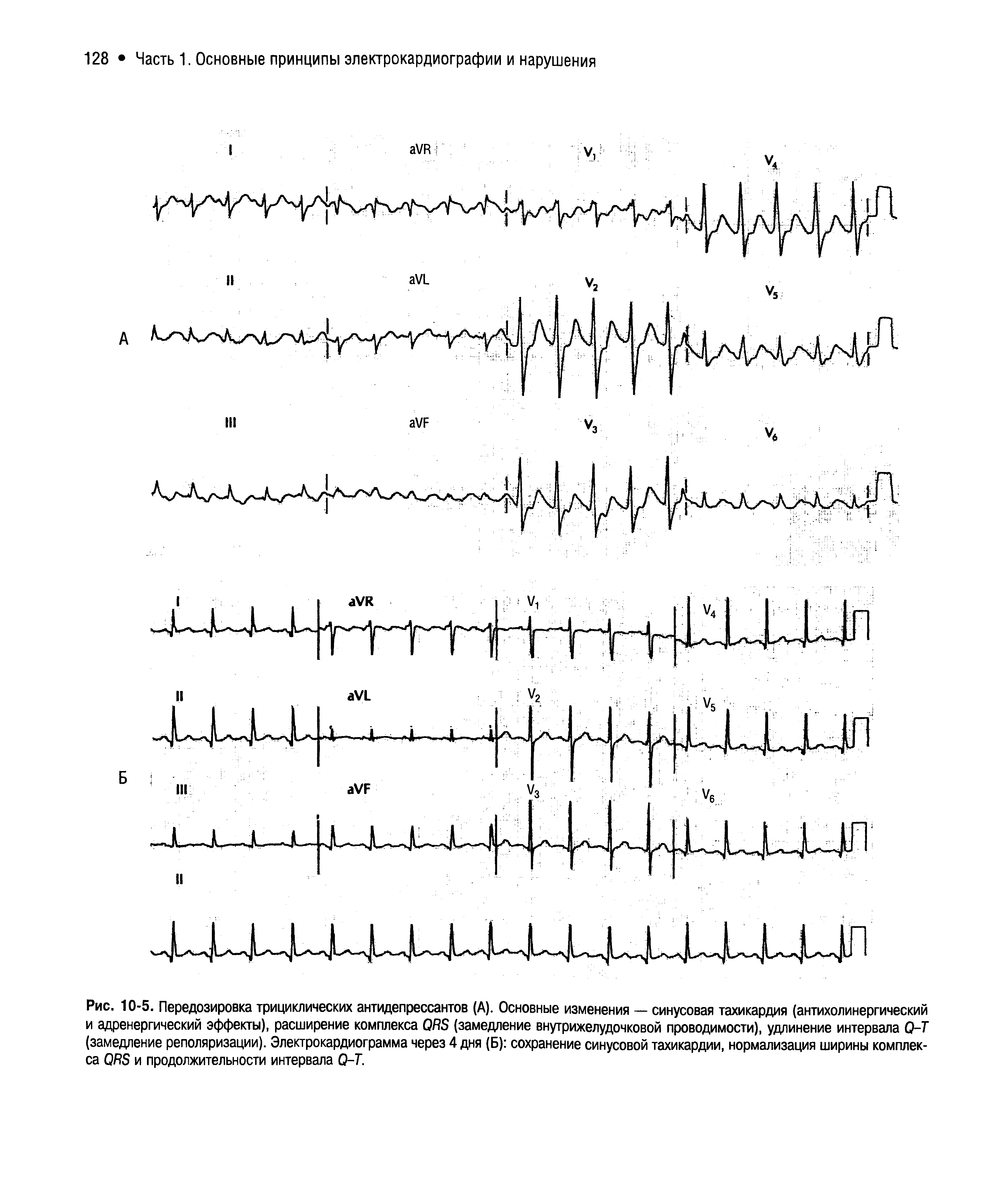 Рис. 10-5. Передозировка трициклических антидепрессантов (А). Основные изменения — синусовая тахикардия (антихолинергический и адренергический эффекты), расширение комплекса ОЯБ (замедление внутрижелудочковой проводимости), удлинение интервала О-Т (замедление реполяризации). Электрокардиограмма через 4 дня (Б) сохранение синусовой тахикардии, нормализация ширины комплекса ОКБ и продолжительности интервала О-Т.
