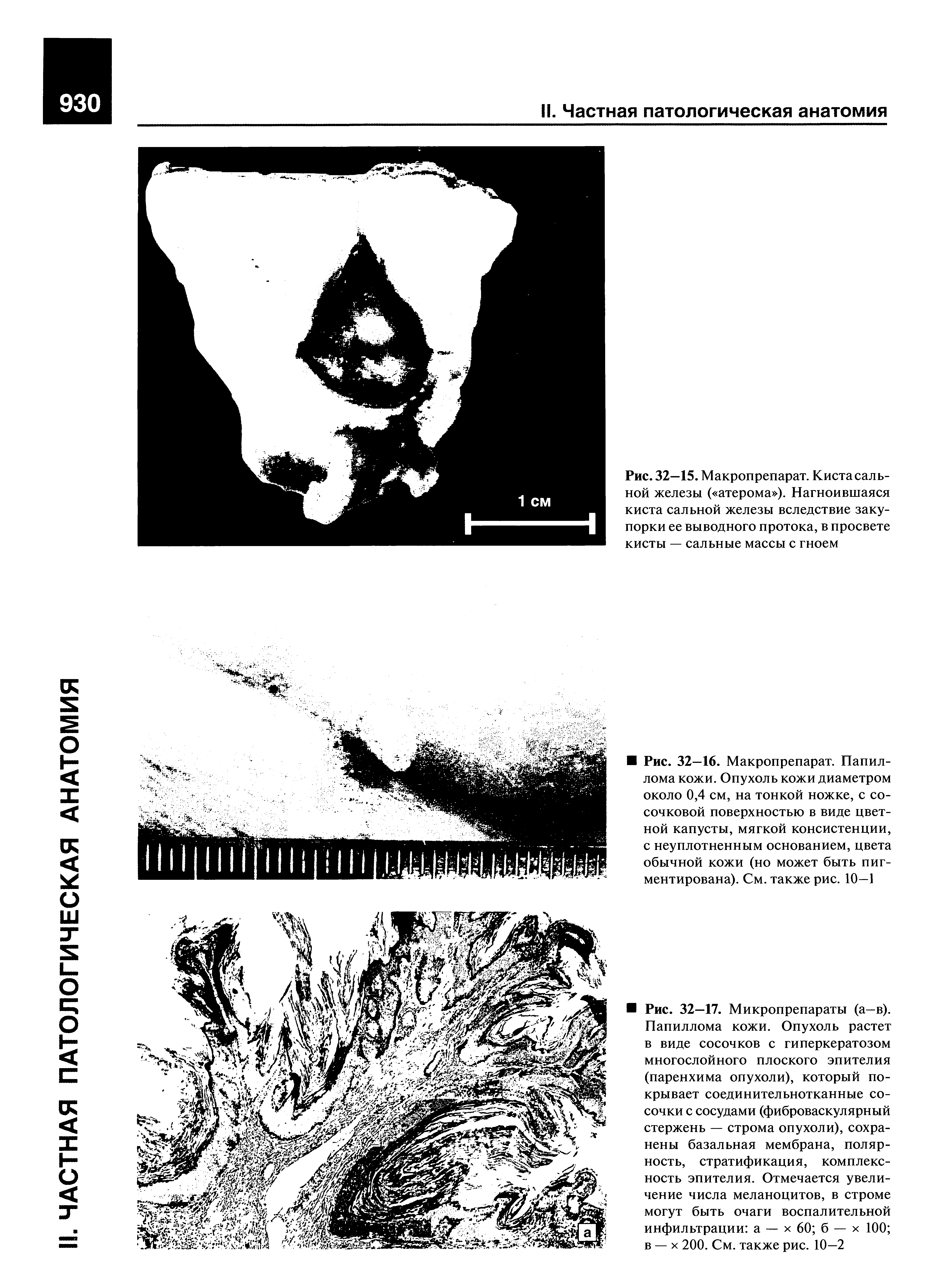 Рис. 32—15. Макропрепарат. Киста сальной железы ( атерома ). Нагноившаяся киста сальной железы вследствие закупорки ее выводного протока, в просвете кисты — сальные массы с гноем...