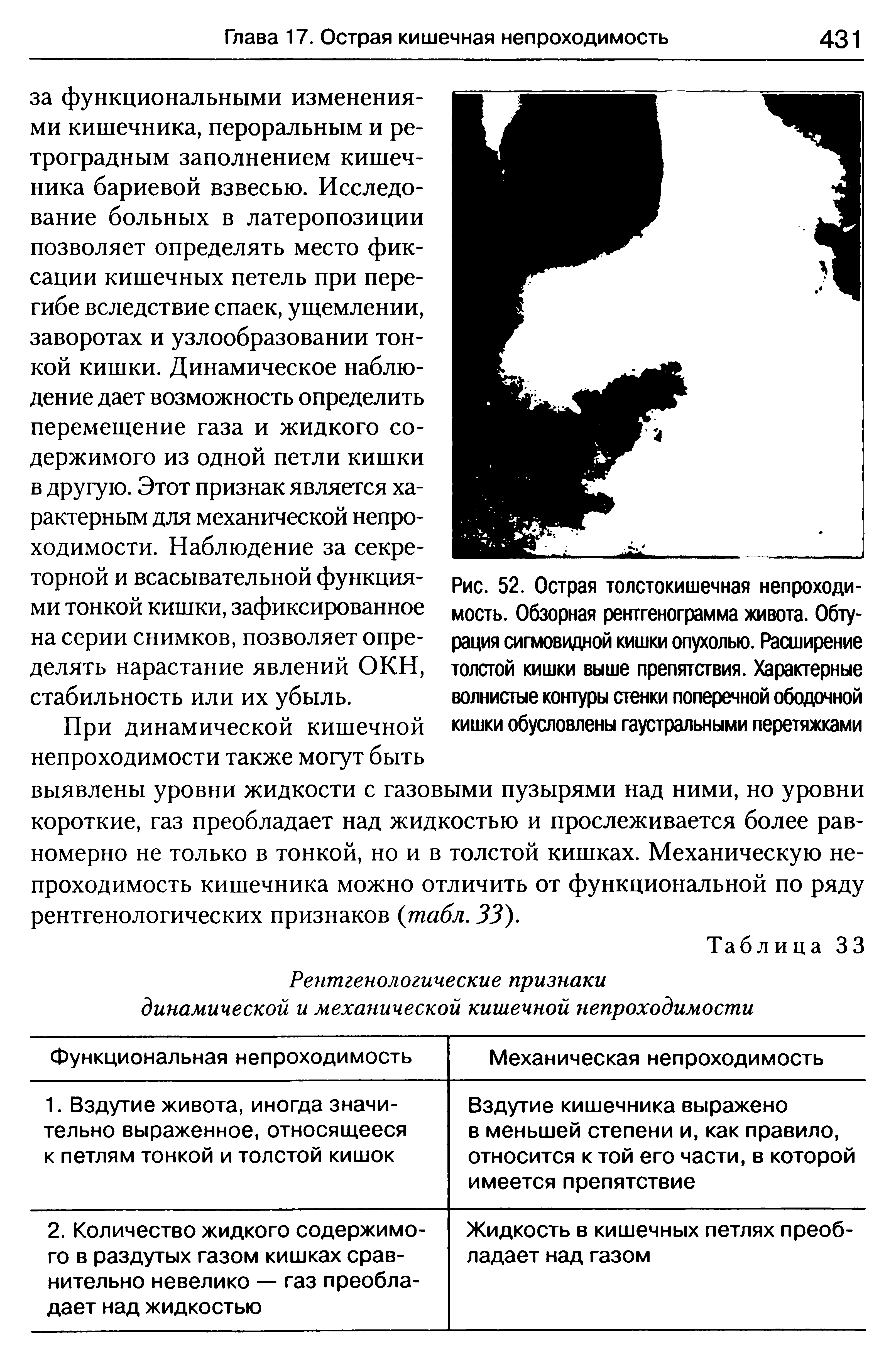 Рис. 52. Острая толстокишечная непроходимость. Обзорная рентгенограмма живота. Обтурация сигмовидной кишки опухолью. Расширение толстой кишки выше препятствия. Характерные волнистые контуры стенки поперечной ободочной кишки обусловлены гаустральными перетяжками...