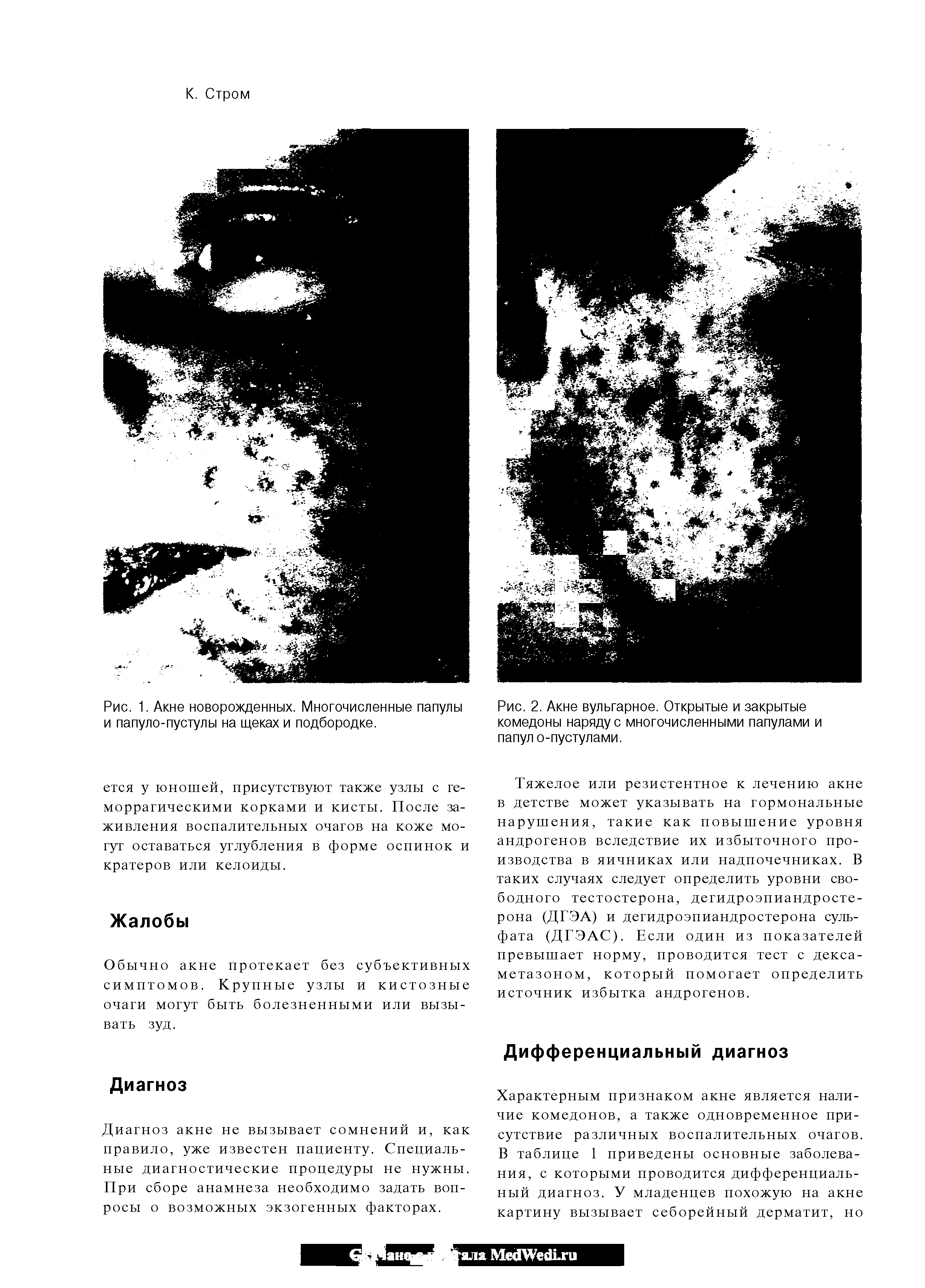 Рис. 2. Акне вульгарное. Открытые и закрытые комедоны наряду с многочисленными папулами и папул о-пустулами.