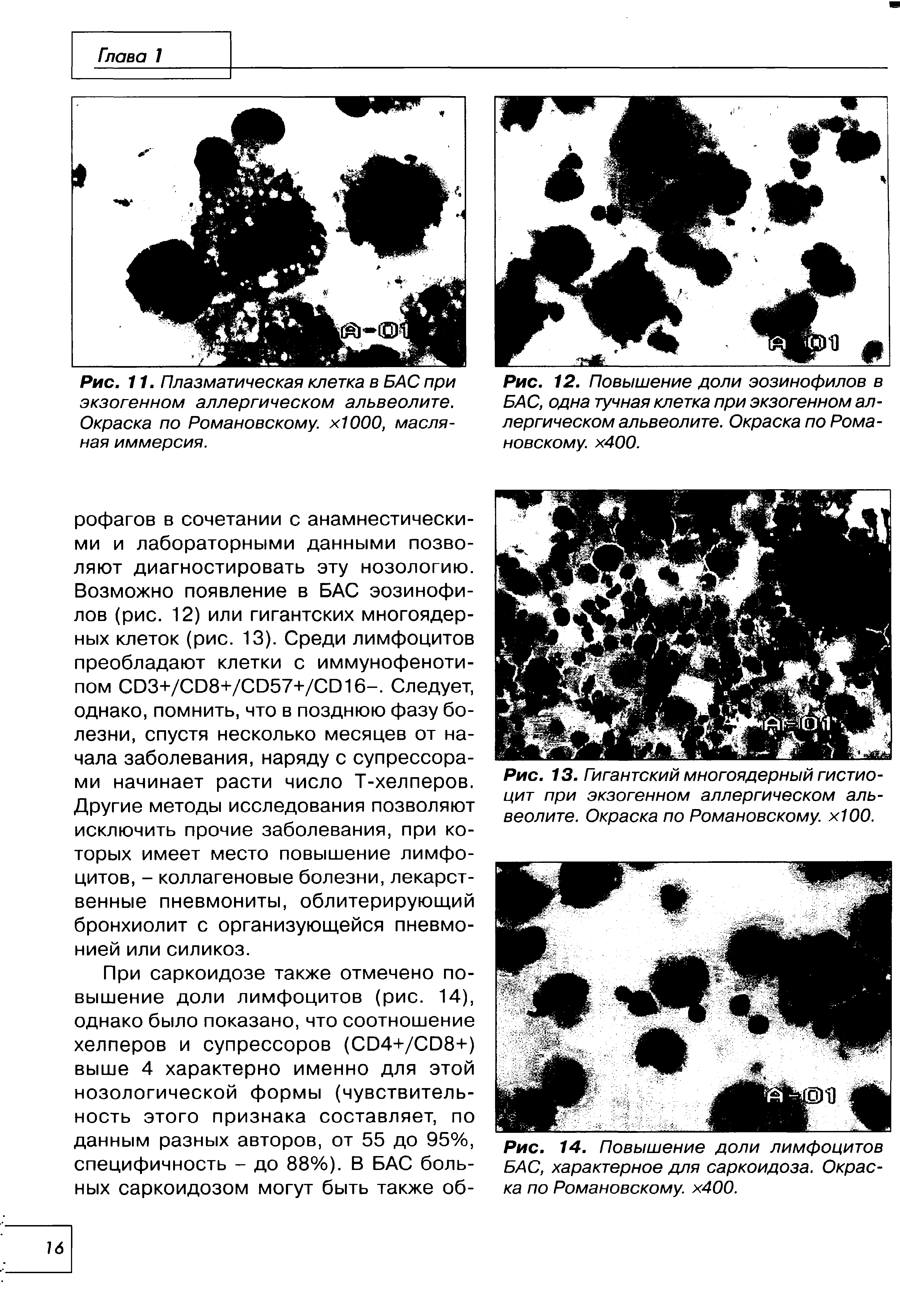 Рис. 12. Повышение доли эозинофилов в БАС, одна тучная клетка при экзогенном аллергическом альвеолите. Окраска по Романовскому. х400.