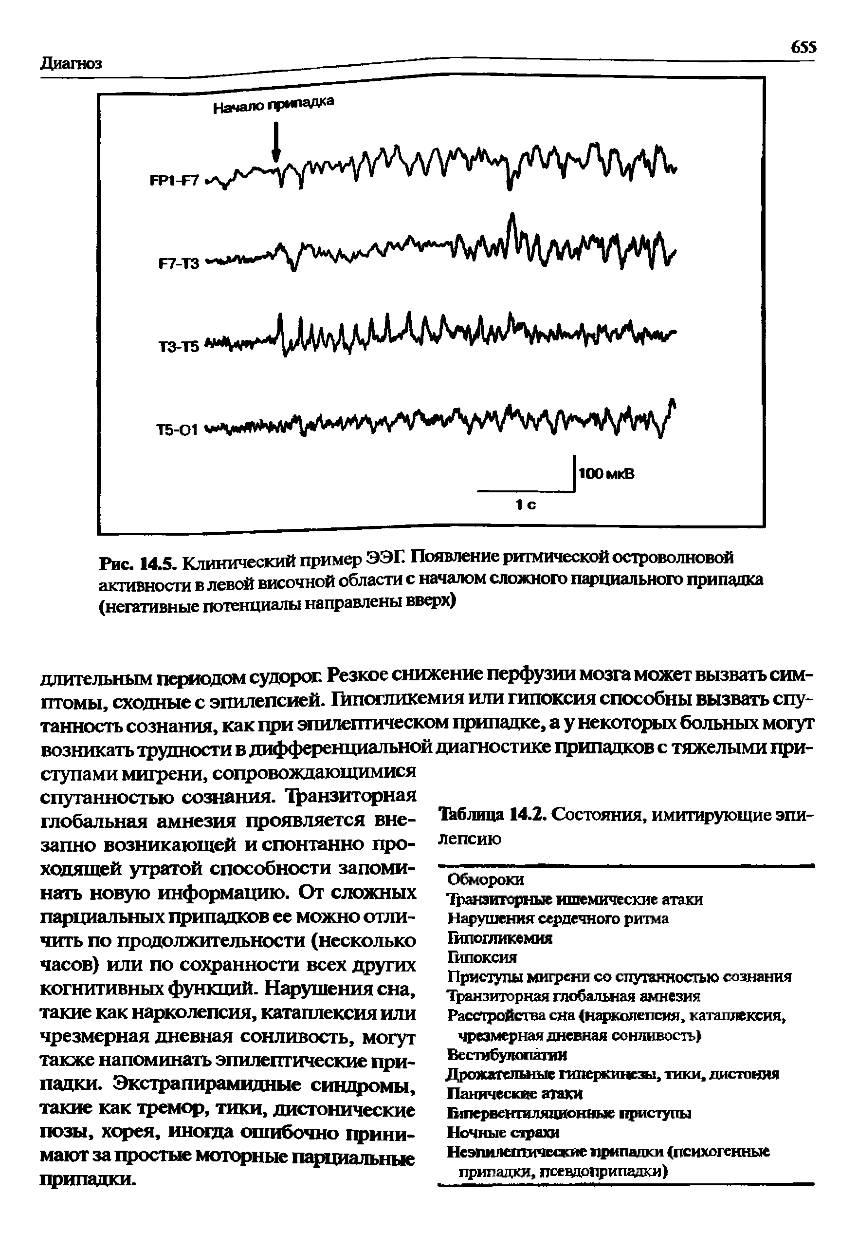 Рис. 14.5. Клинический пример ЭЭГ. Появление ритмической островолновой активности в левой височной области с началом сложного парциального припадка (негативные потенциалы направлены вверх)...
