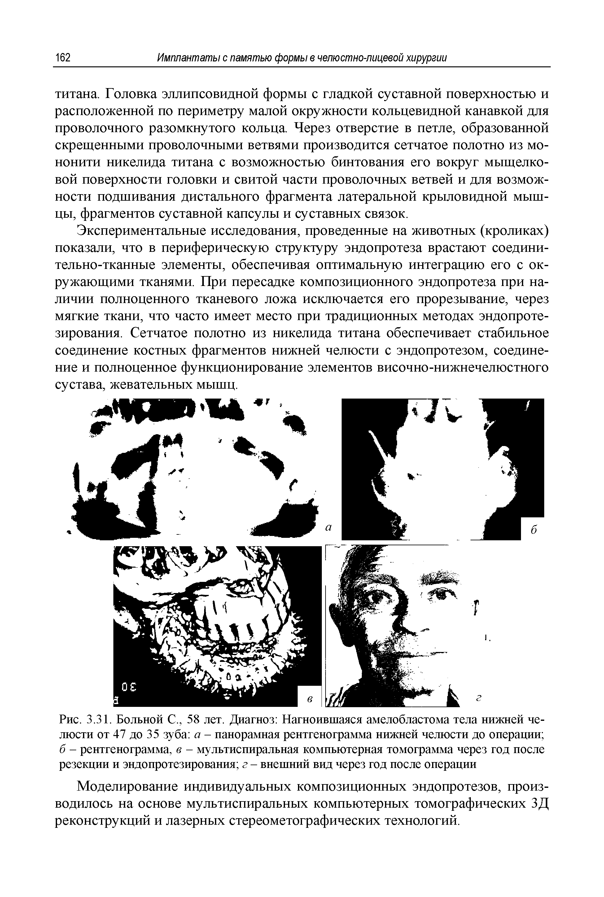 Рис. 3.31. Больной С., 58 лет. Диагноз Нагноившаяся амелобластома тела нижней челюсти от 47 до 35 зуба а - панорамная рентгенограмма нижней челюсти до операции б - рентгенограмма, в - мультиспиральная компьютерная томограмма через год после резекции и эндопротезирования г - внешний вид через год после операции...