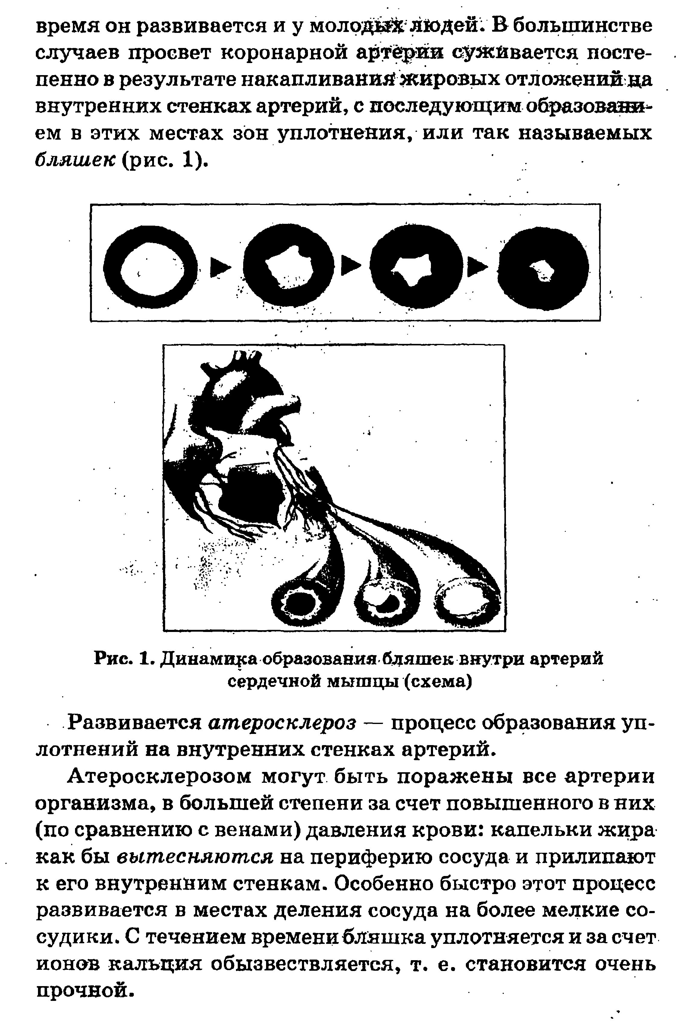 Рис. 1. Динамщса образования бдяшек внутри артерий сердечной мышцы (схема)...