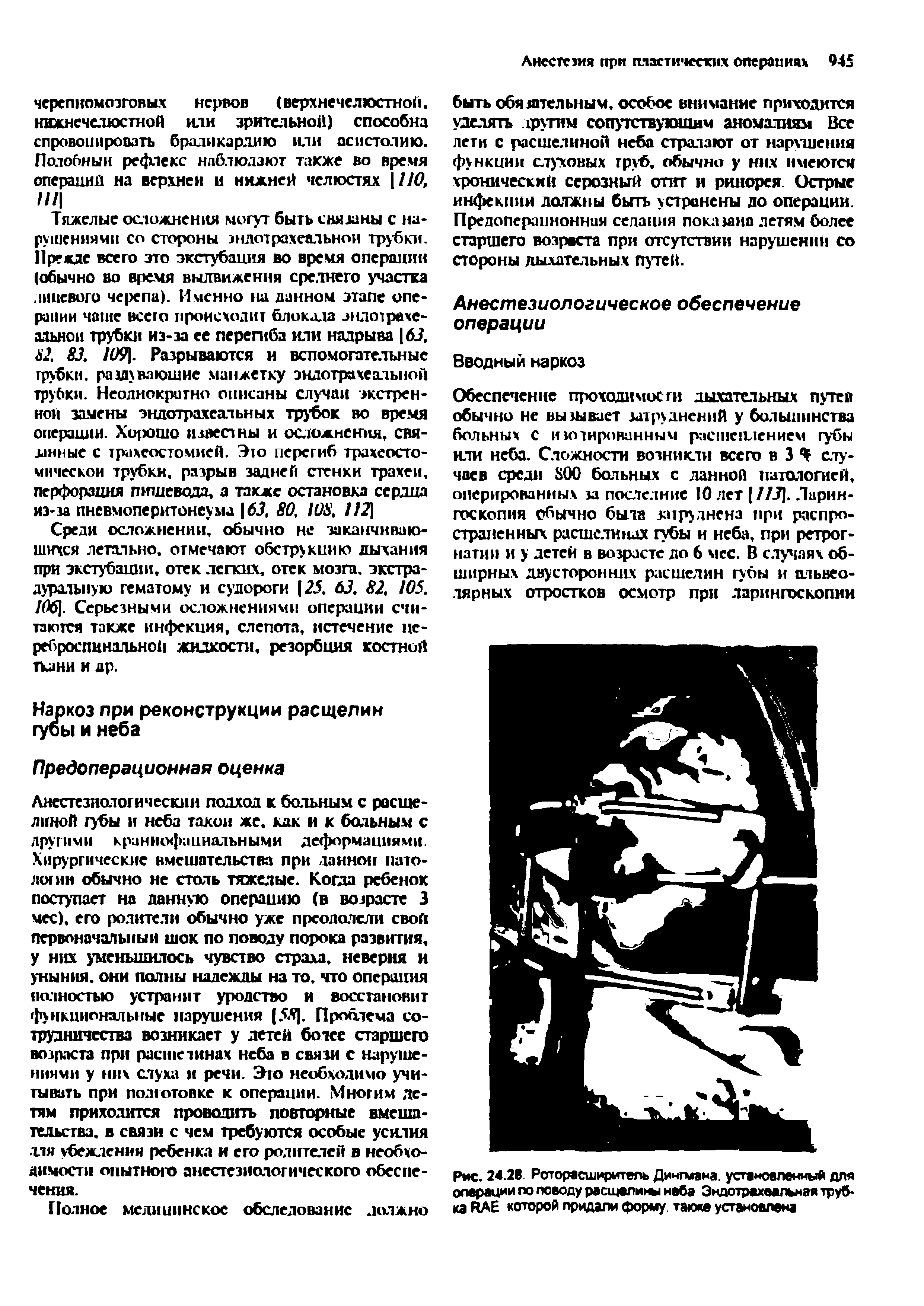 Рис. 24.28. Роторасширитель Дингмана, установленный для операции по поводу расщелин неба Эндотрахвальмая трубка RAE которой придали форму также установлена...